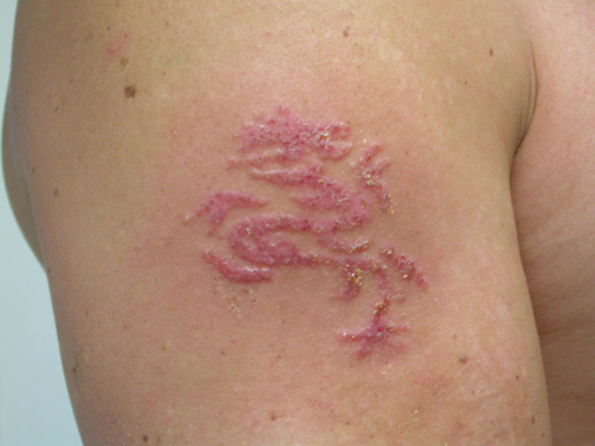 Contact eczema due to henna