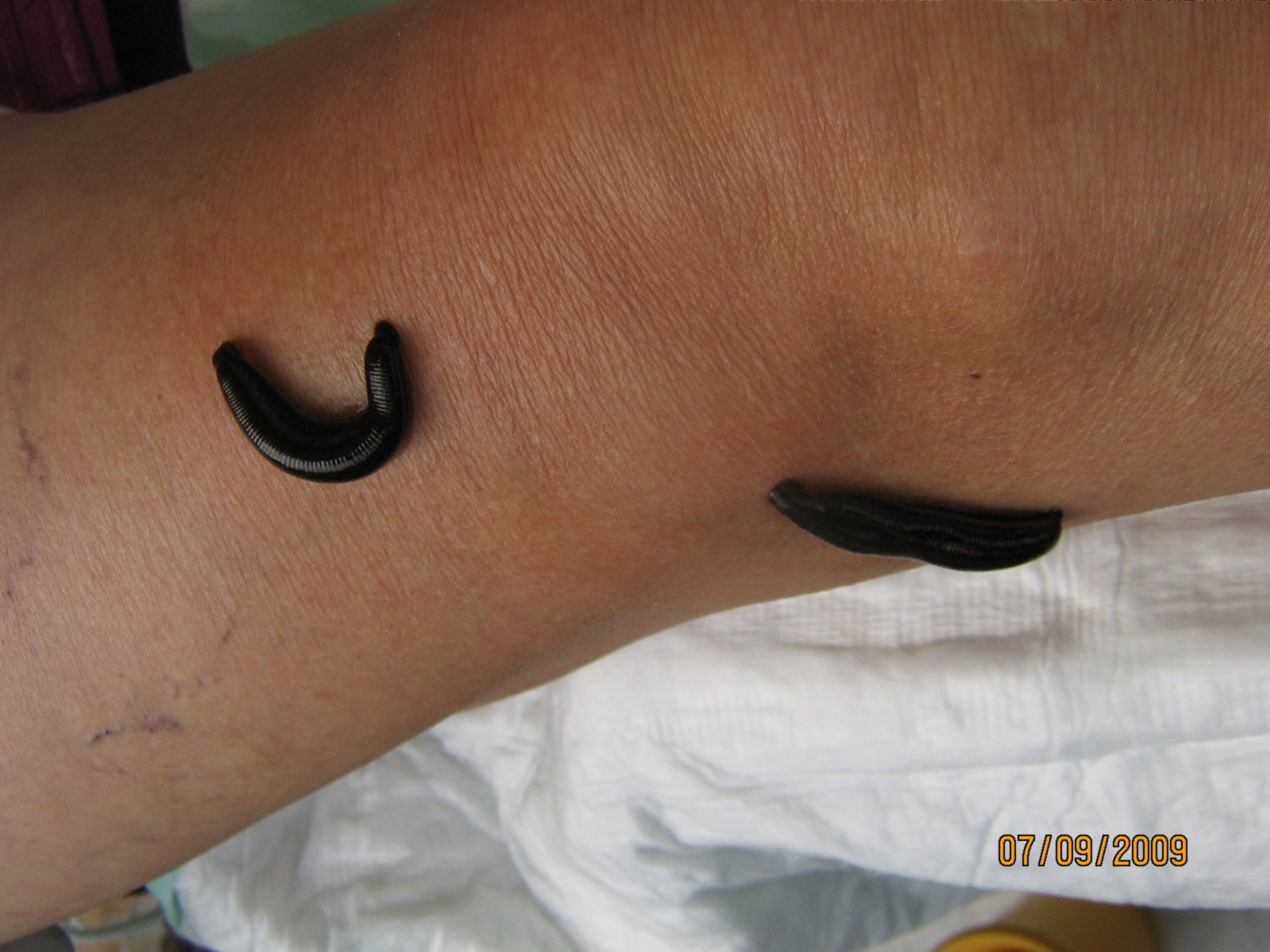 Two leeches on a knee- therapy for arthrosis
