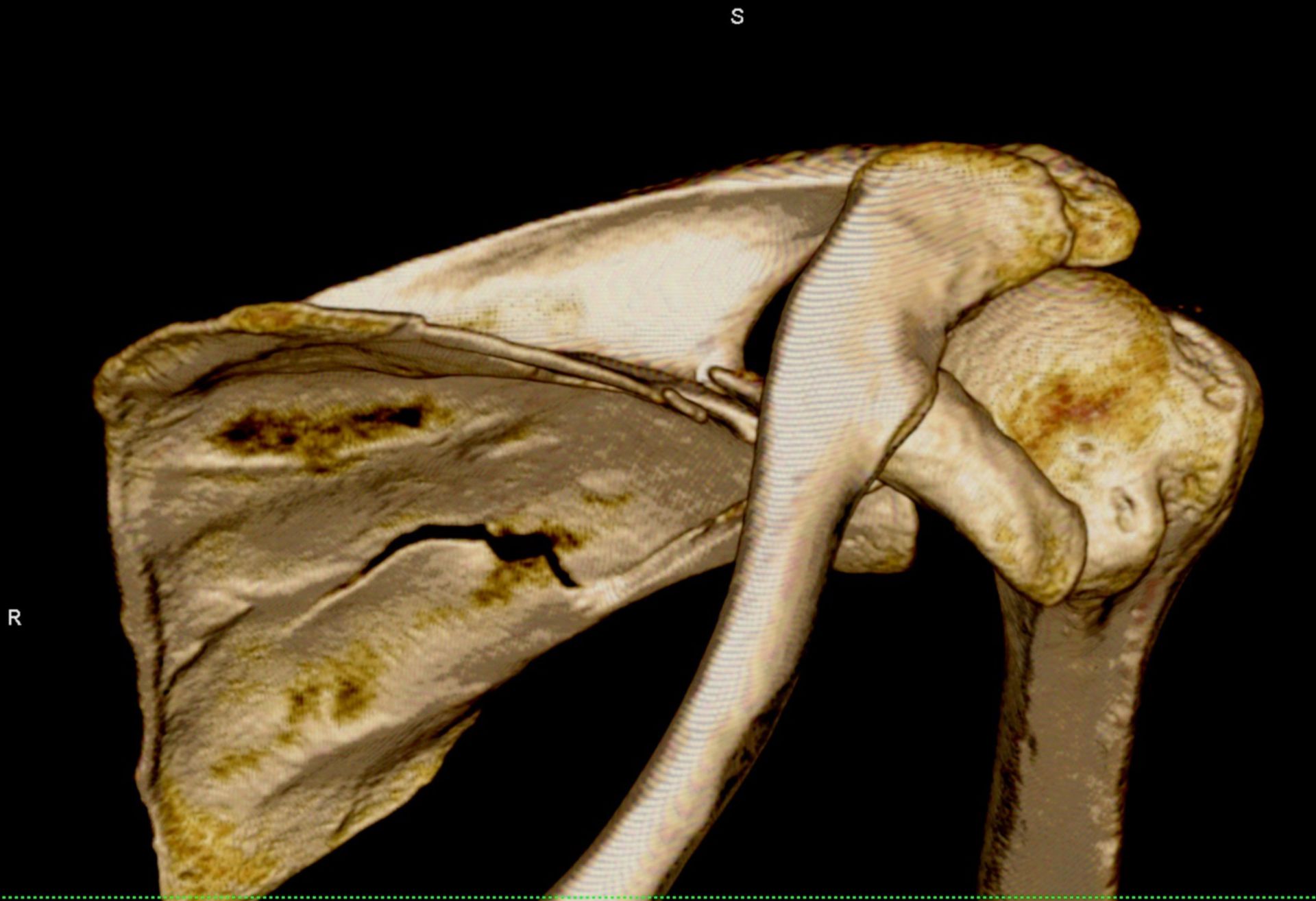 3D Rekonstruktion einer CT der Schulter mit Darstellung einer mehrfragmentären Skapulafraktur