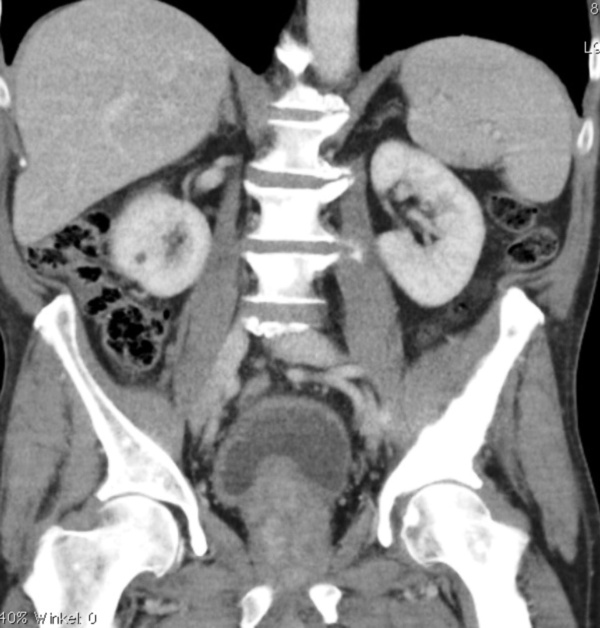 Ursache Schluckstörungen -Metastase eines Prostata Ca der Schädelbasis