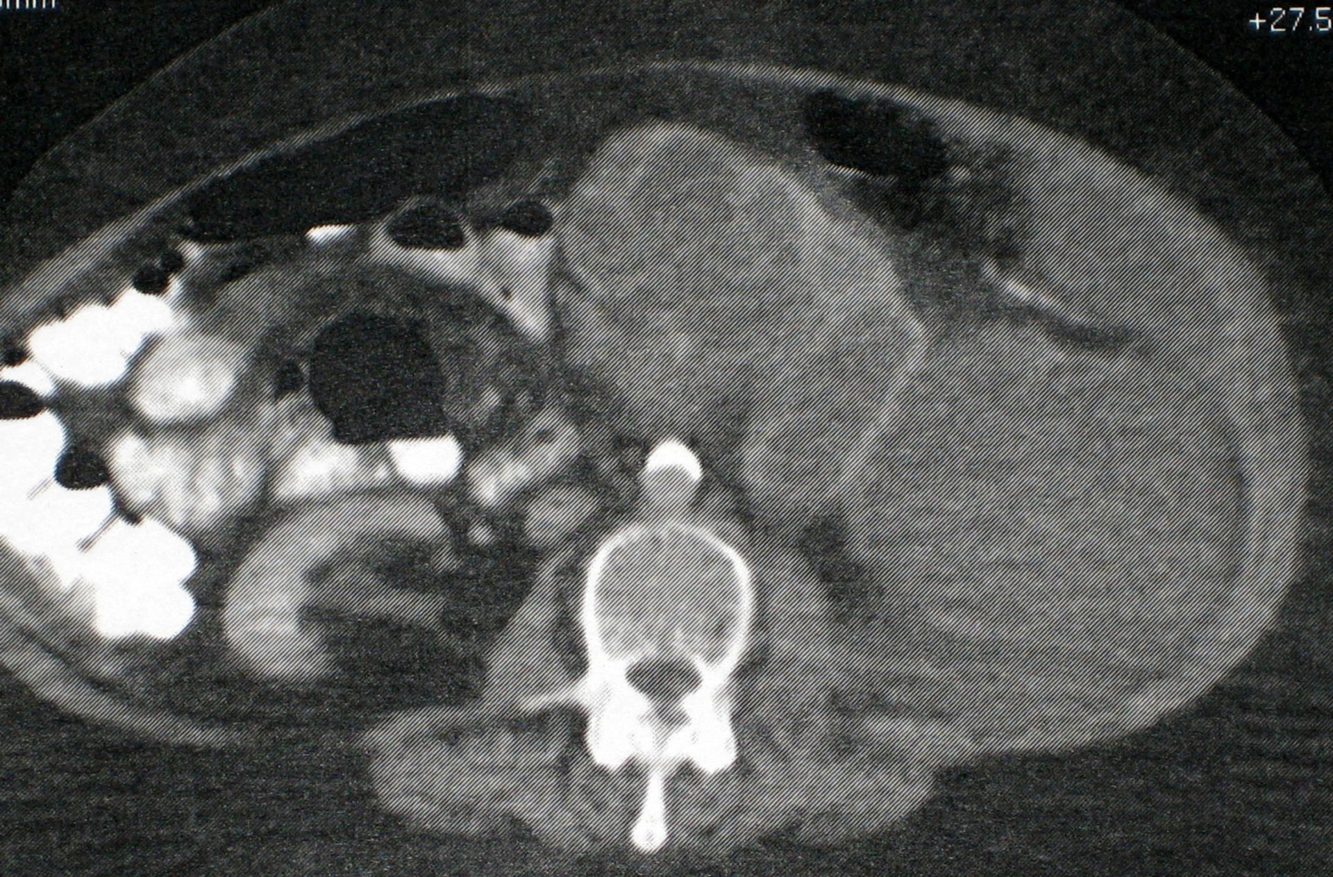 Kidney tumor - CT