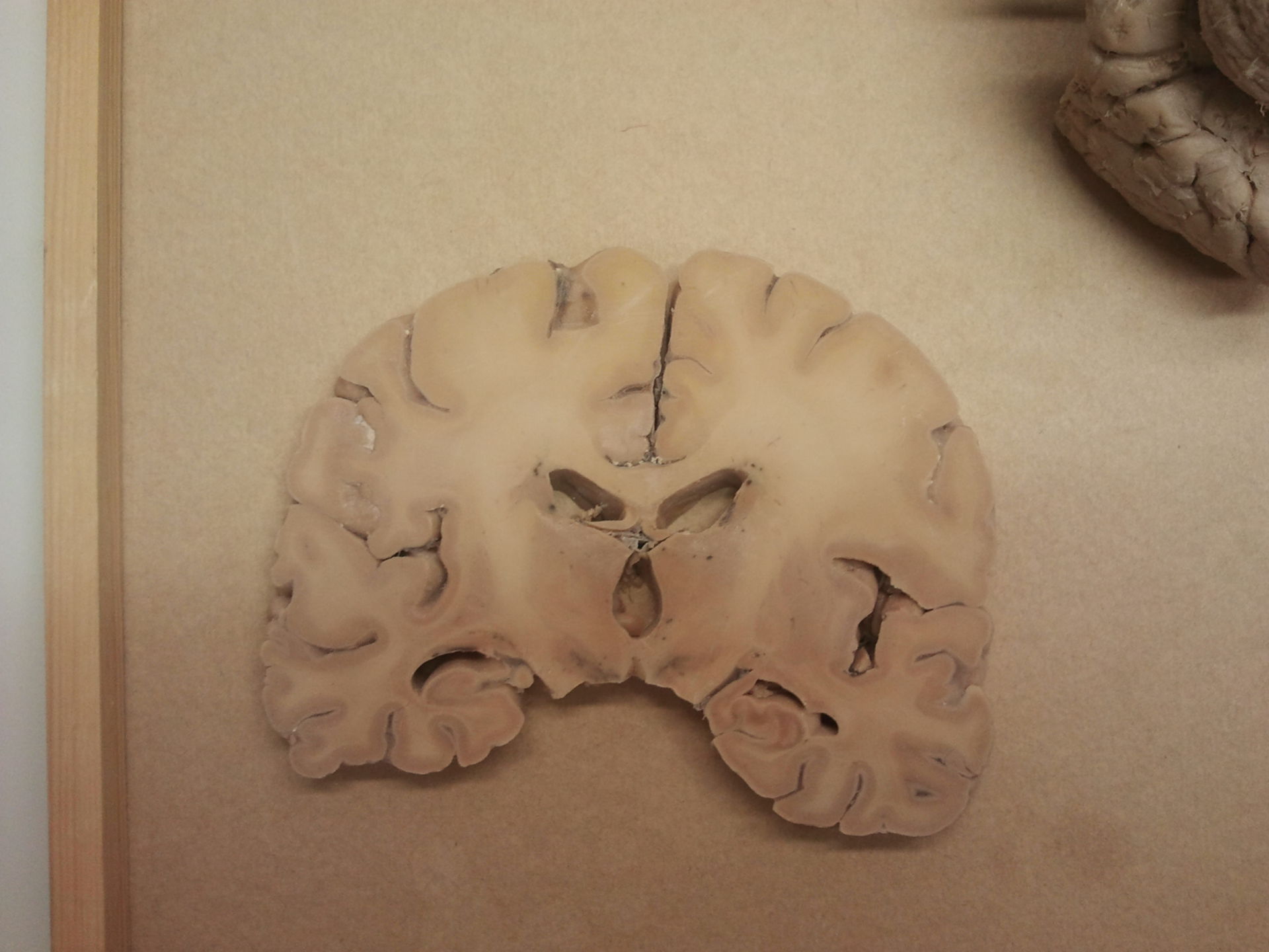 Sezione del cervello