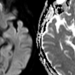 Hirninfarkt - DocCheck Flexikon