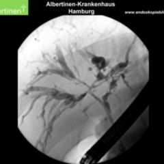 KlatskinTumor DocCheck Flexikon