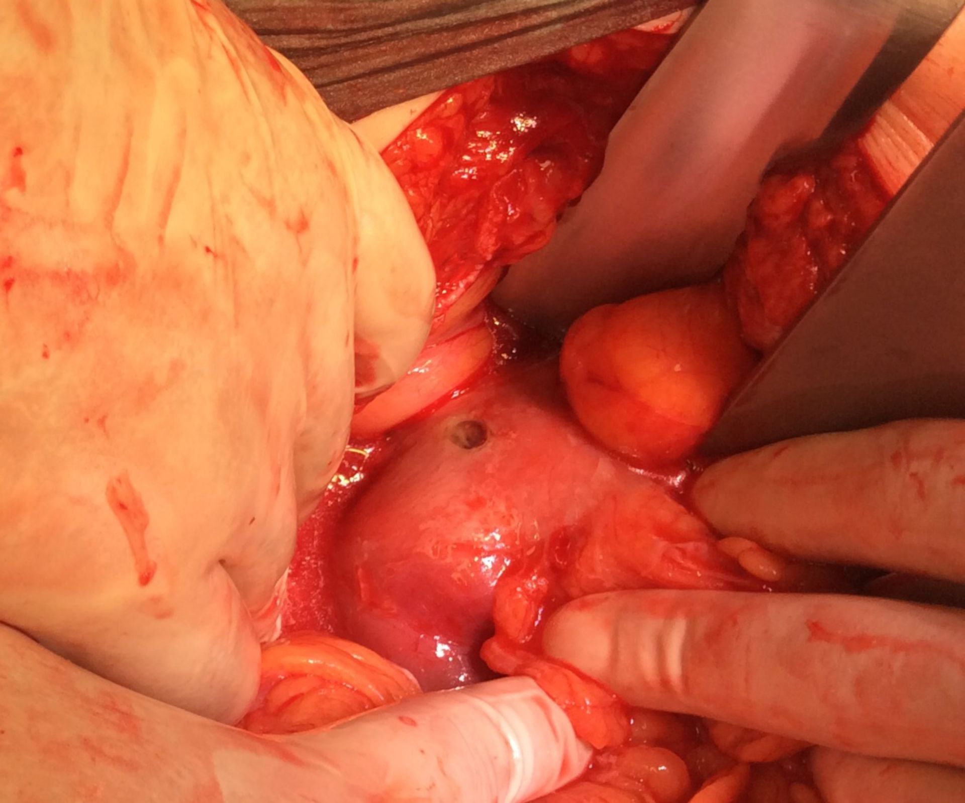 Duodenal ulcer - perforation
