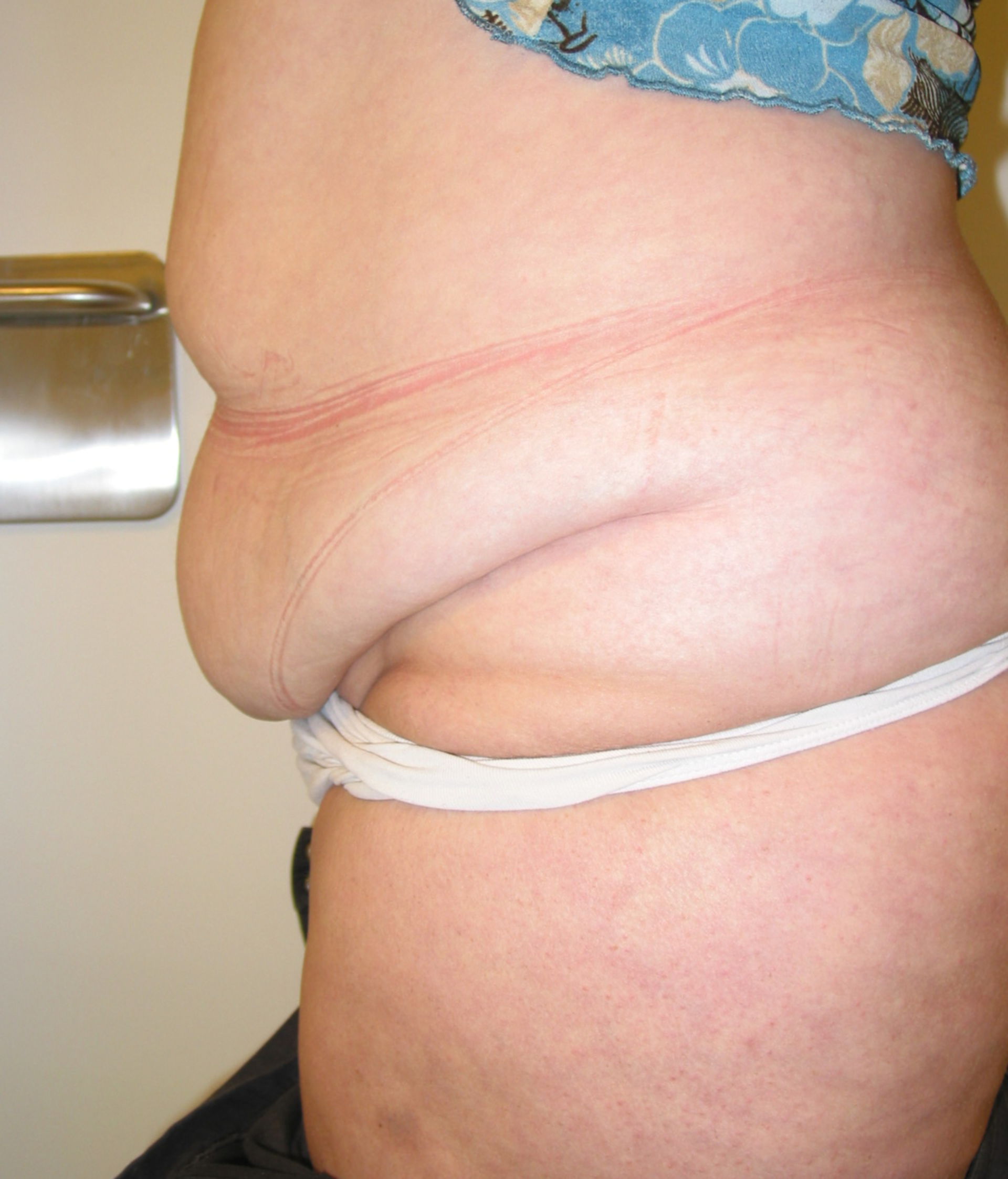 Adipose patient after weight loss