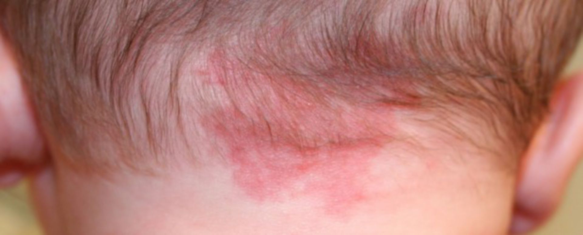 labio de hemangioma de fresa