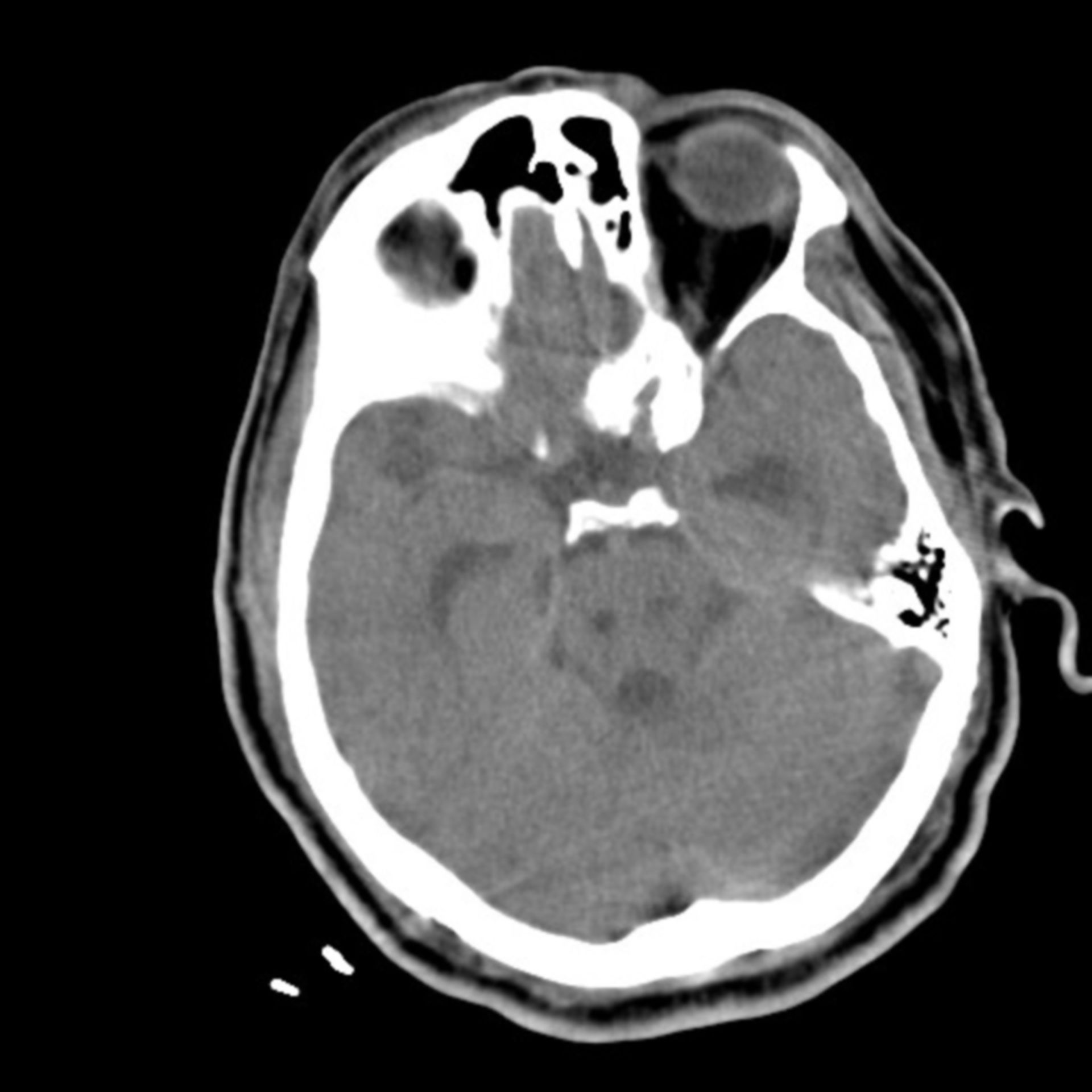 Gehirnblutung+Pneumonie 14