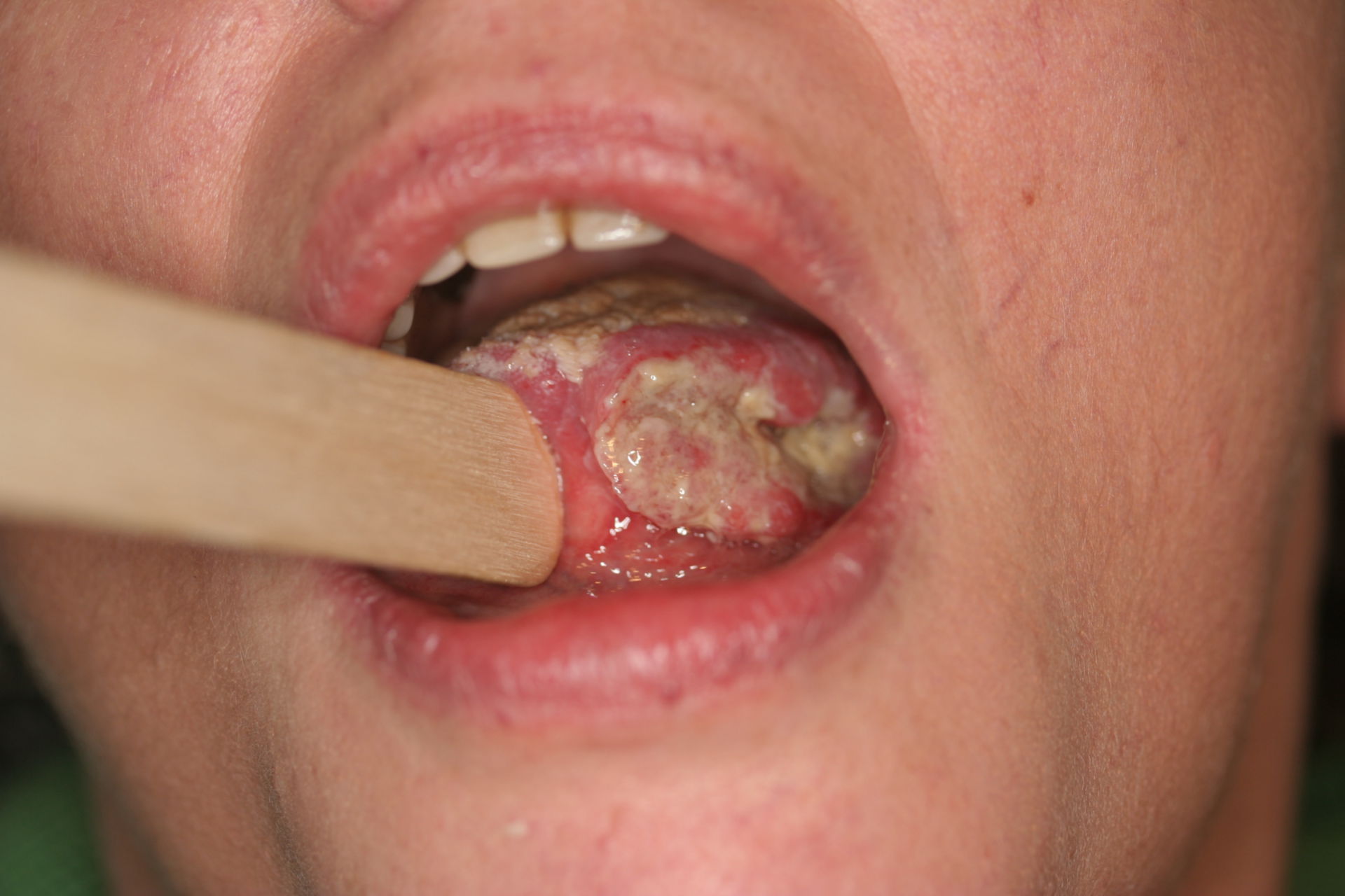 Cancer oral