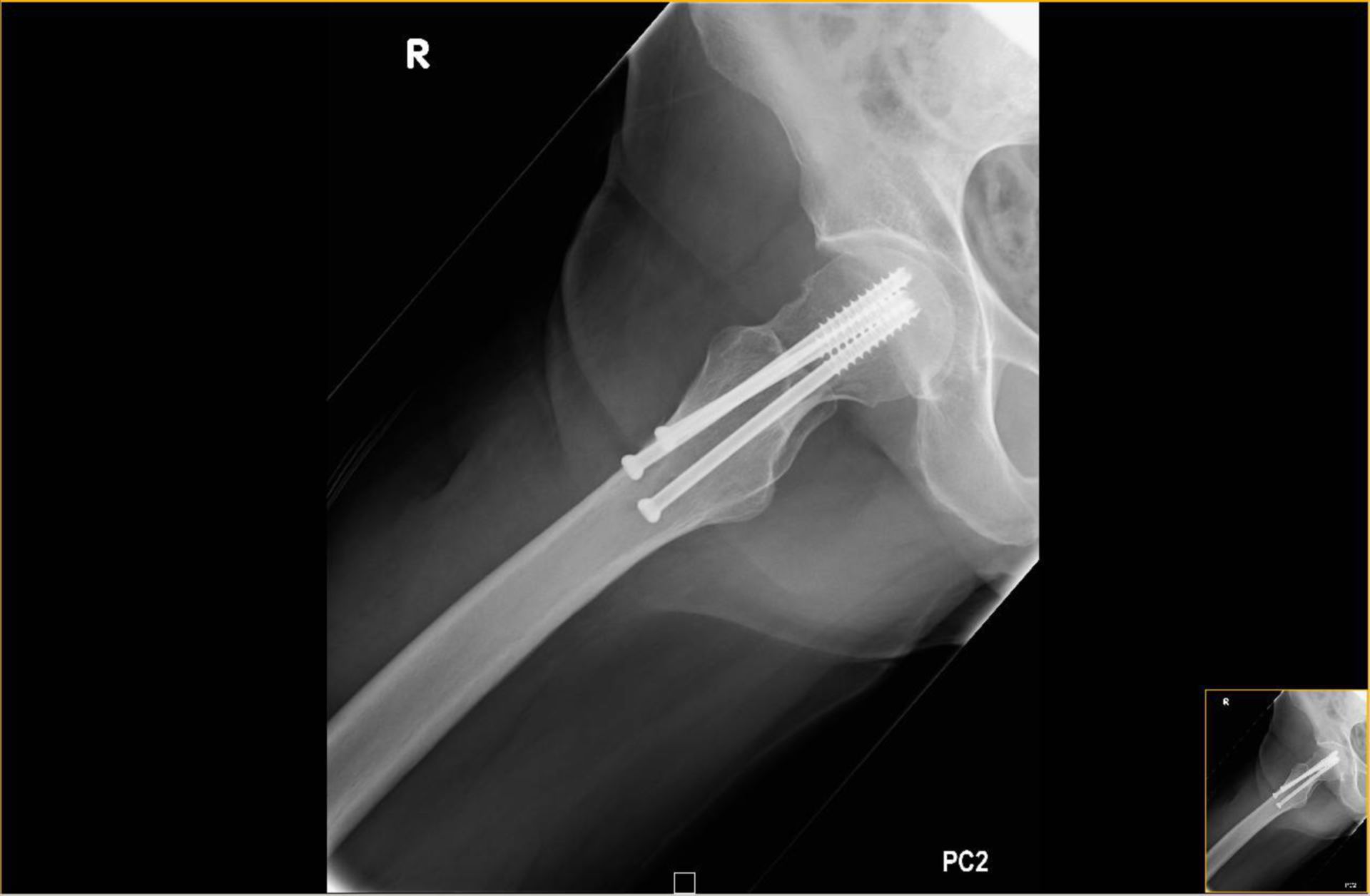 Skrew osteosynthesis of medial femoral neck fracture