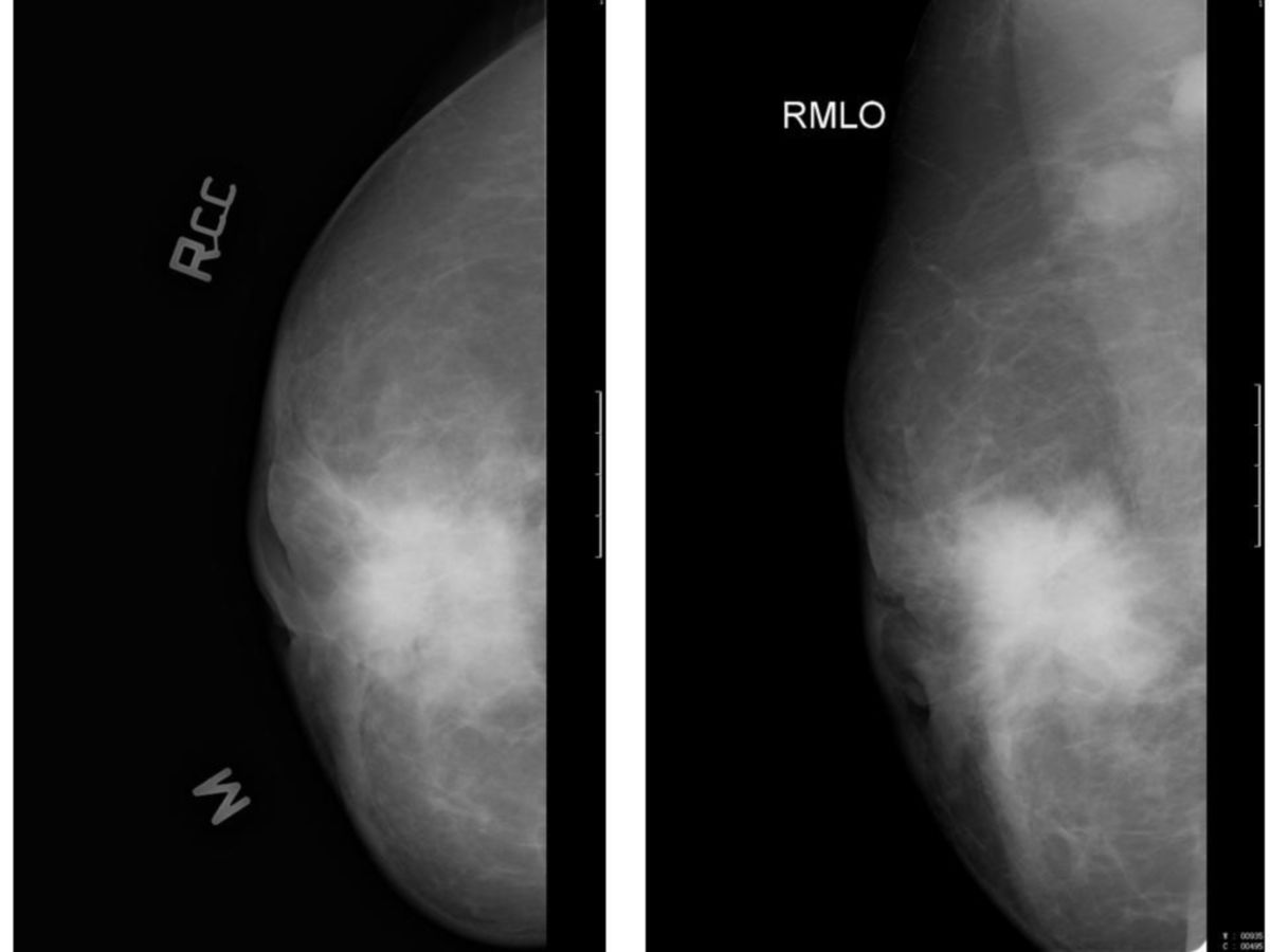 Brustkrebs (Mammographie)