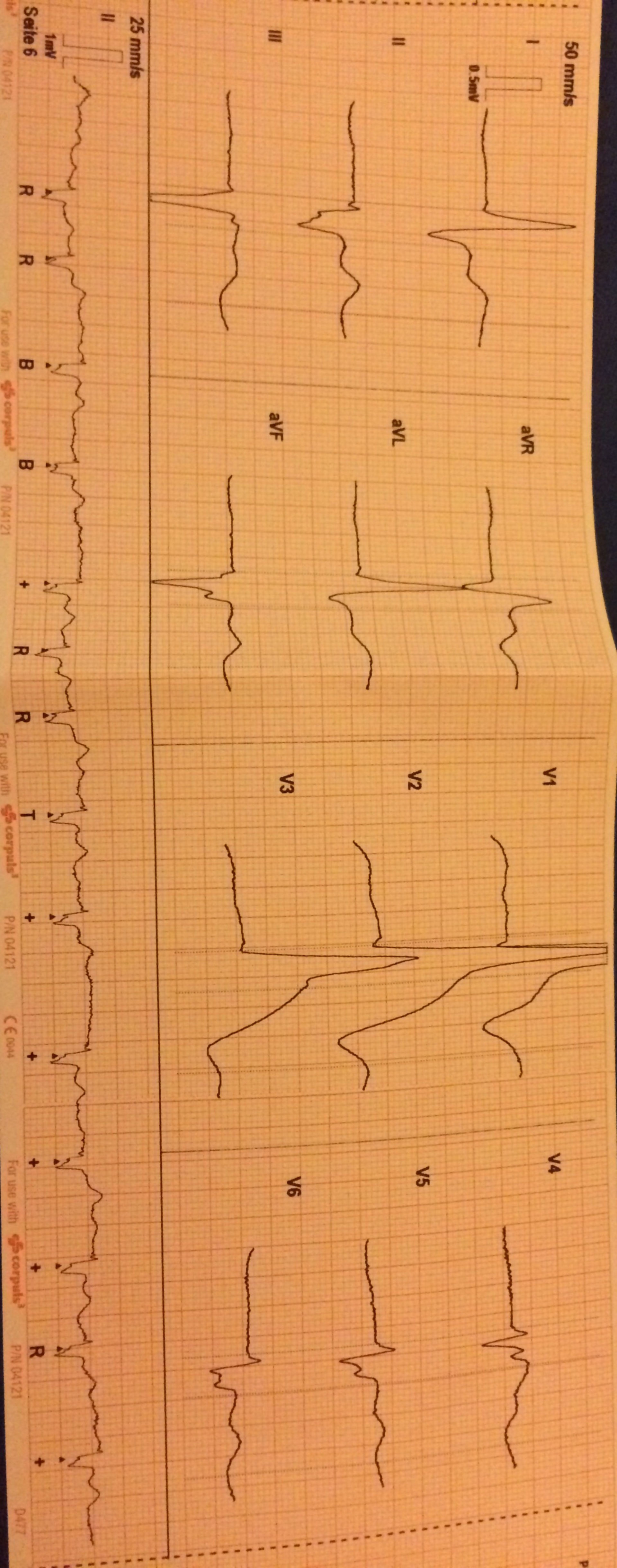 EKG Aufnahme einer 90-jährigen Patientin