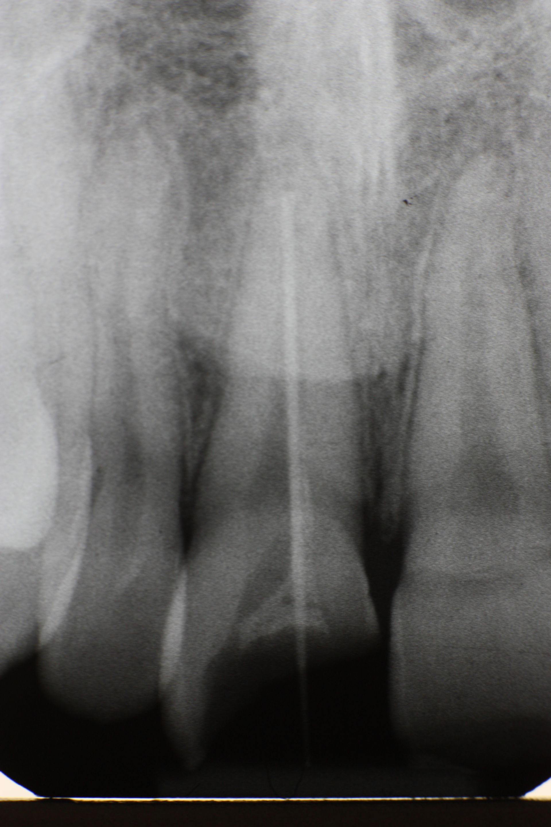 Trauma of the frontal tooth (3)