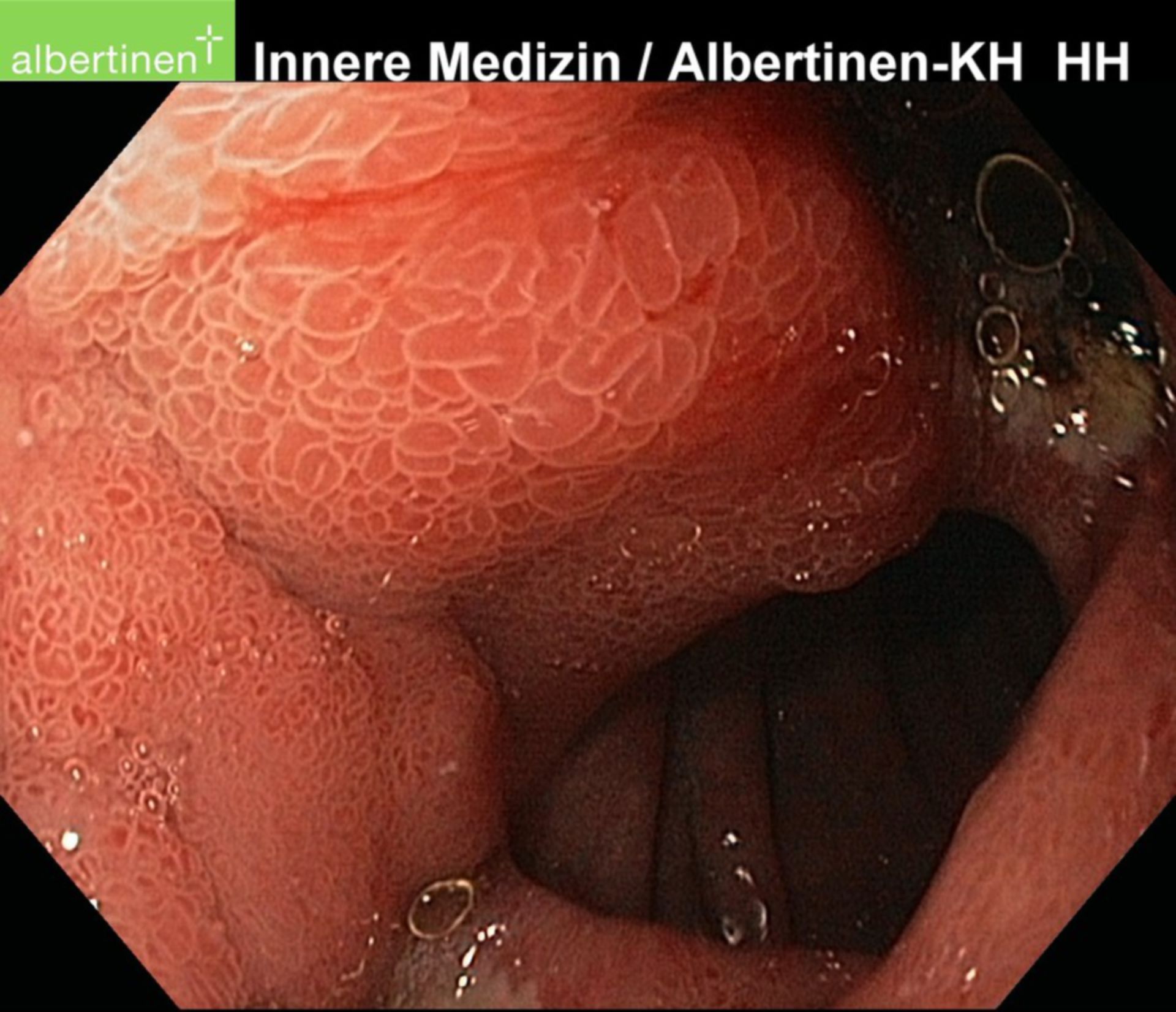 Flat ulcers (3)