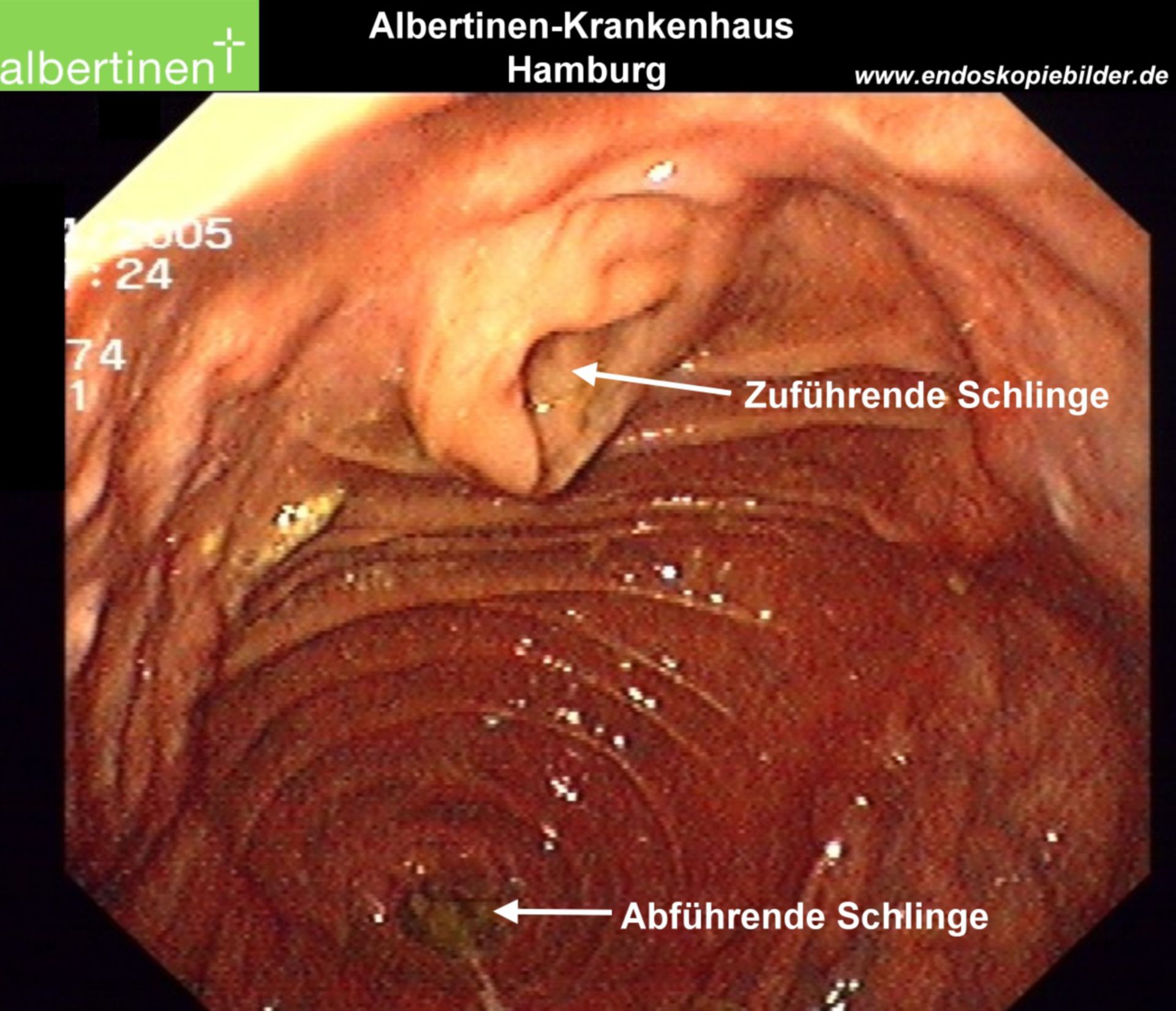 Endoscopy: Billroth II stomach