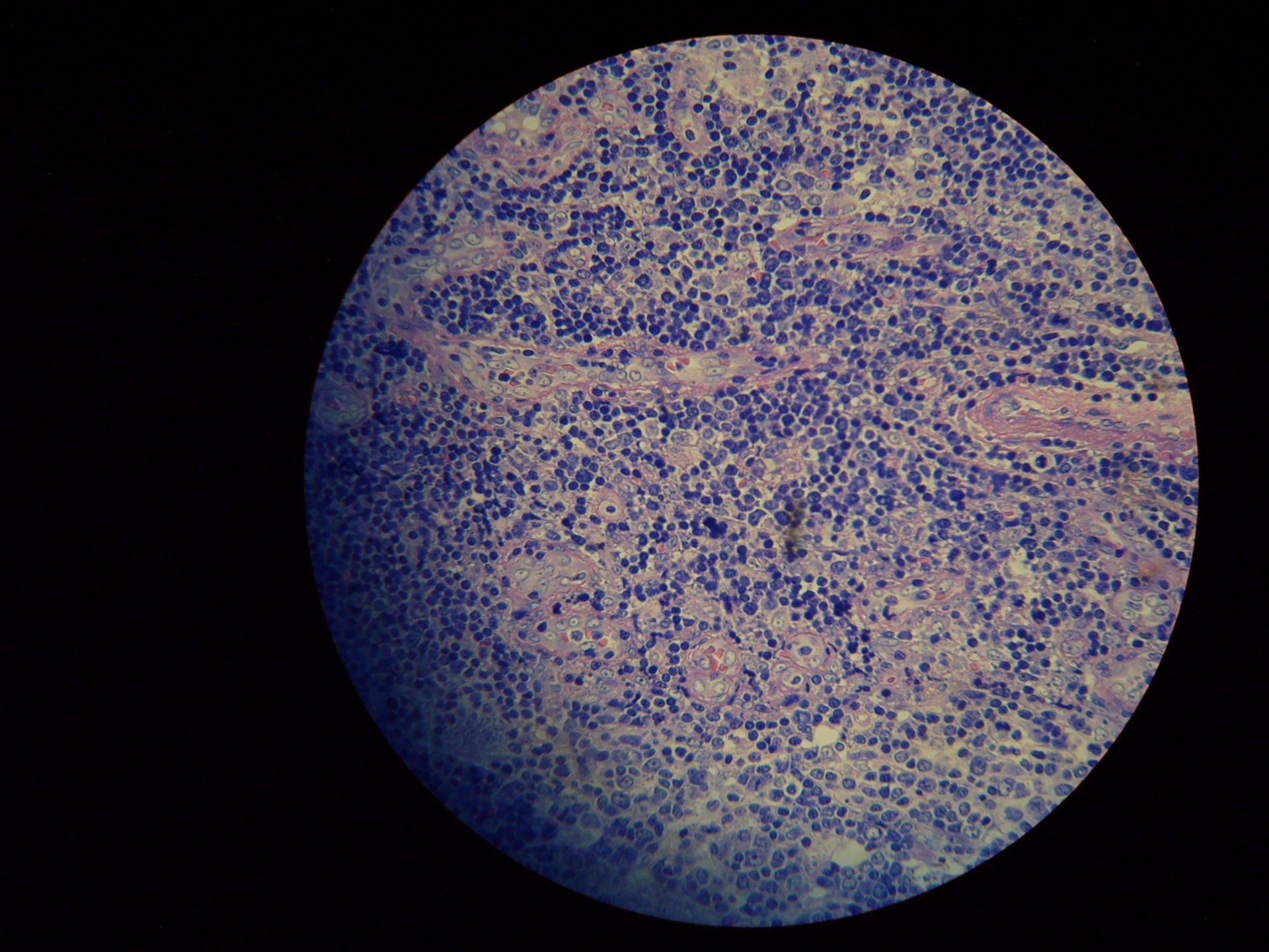 Visceral leishmaniasis lymph node