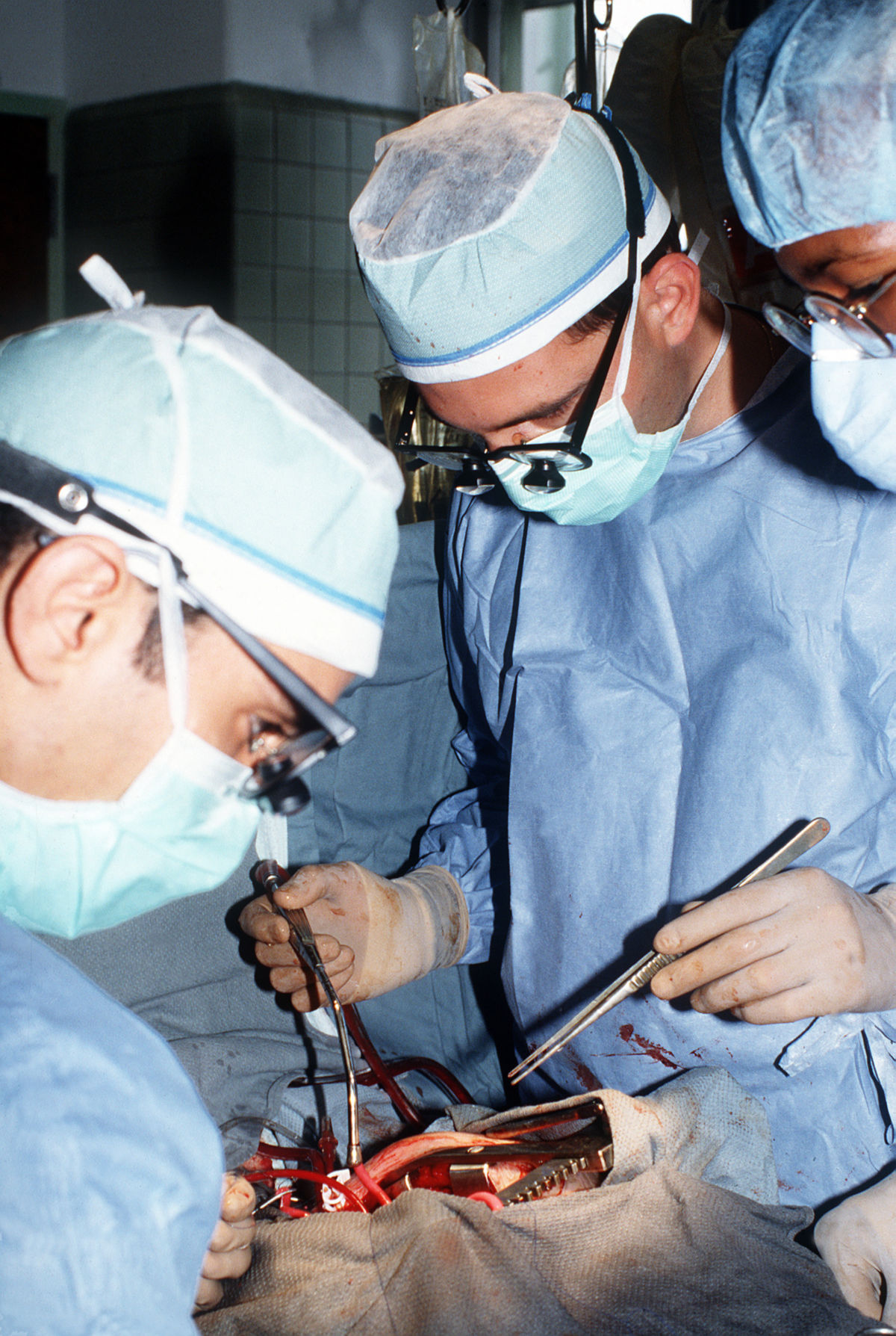 Chirurgen bei Mitralklappenersatz-Operation
