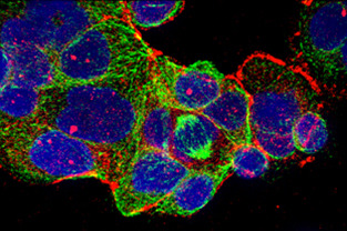 Speiseröhrenkrebszellen in der Petrischale angefärbt: Blau: DNA im Zellkern, Rot und Grün: Eiweißstoffe in der Zelle. © Universitätsklinikum Freiburg