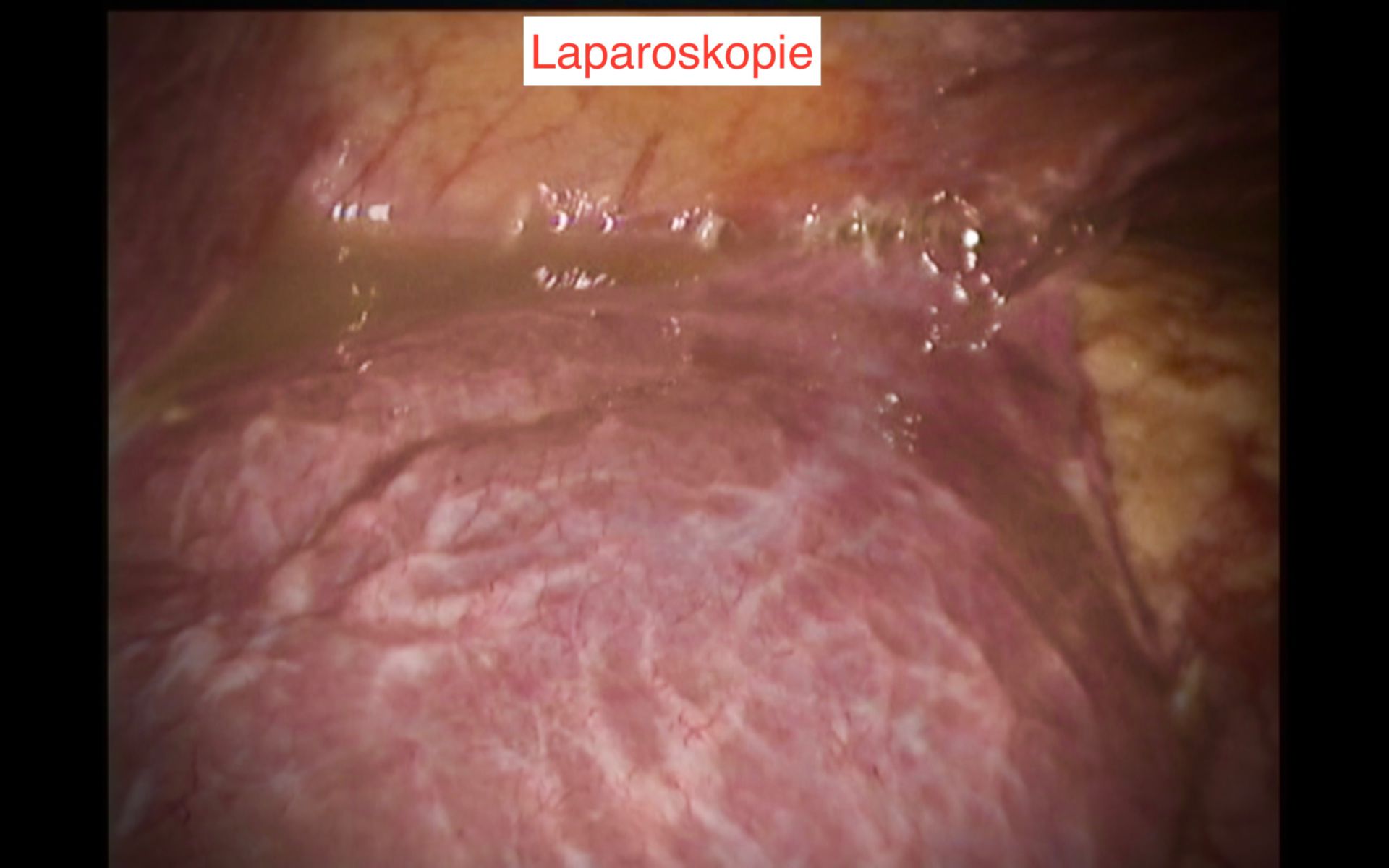 Peritonitis bei Querkolonperforation
