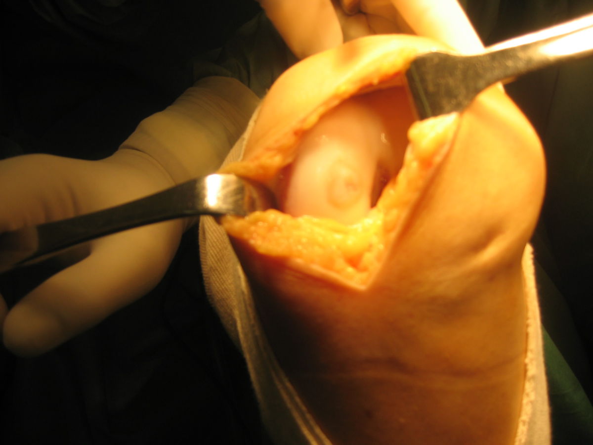 Chondrozyten Transplantation in Knie
