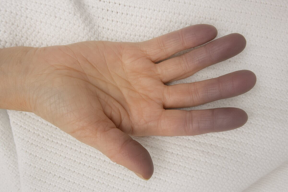 Zyanose: So sieht’s aus