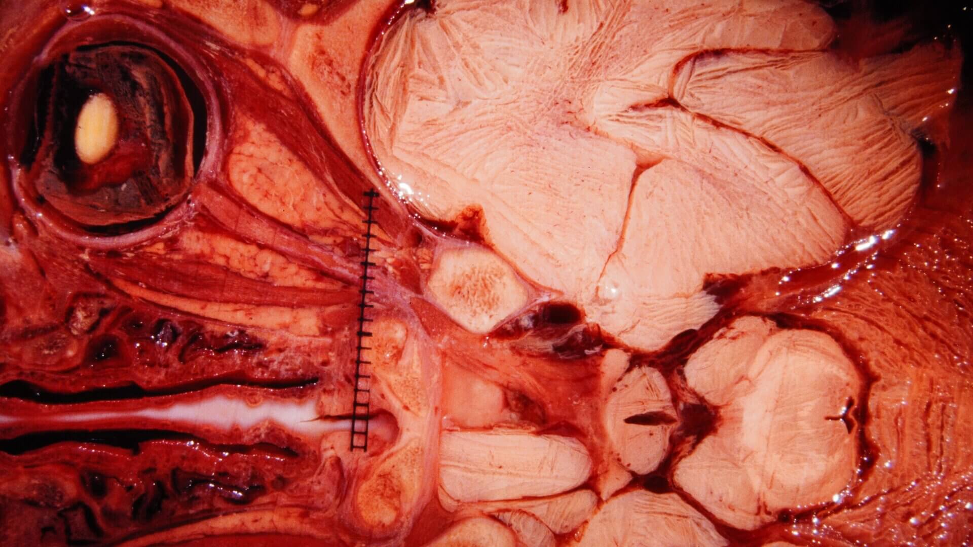 Transversalschnitt Höhe Nervus opticus