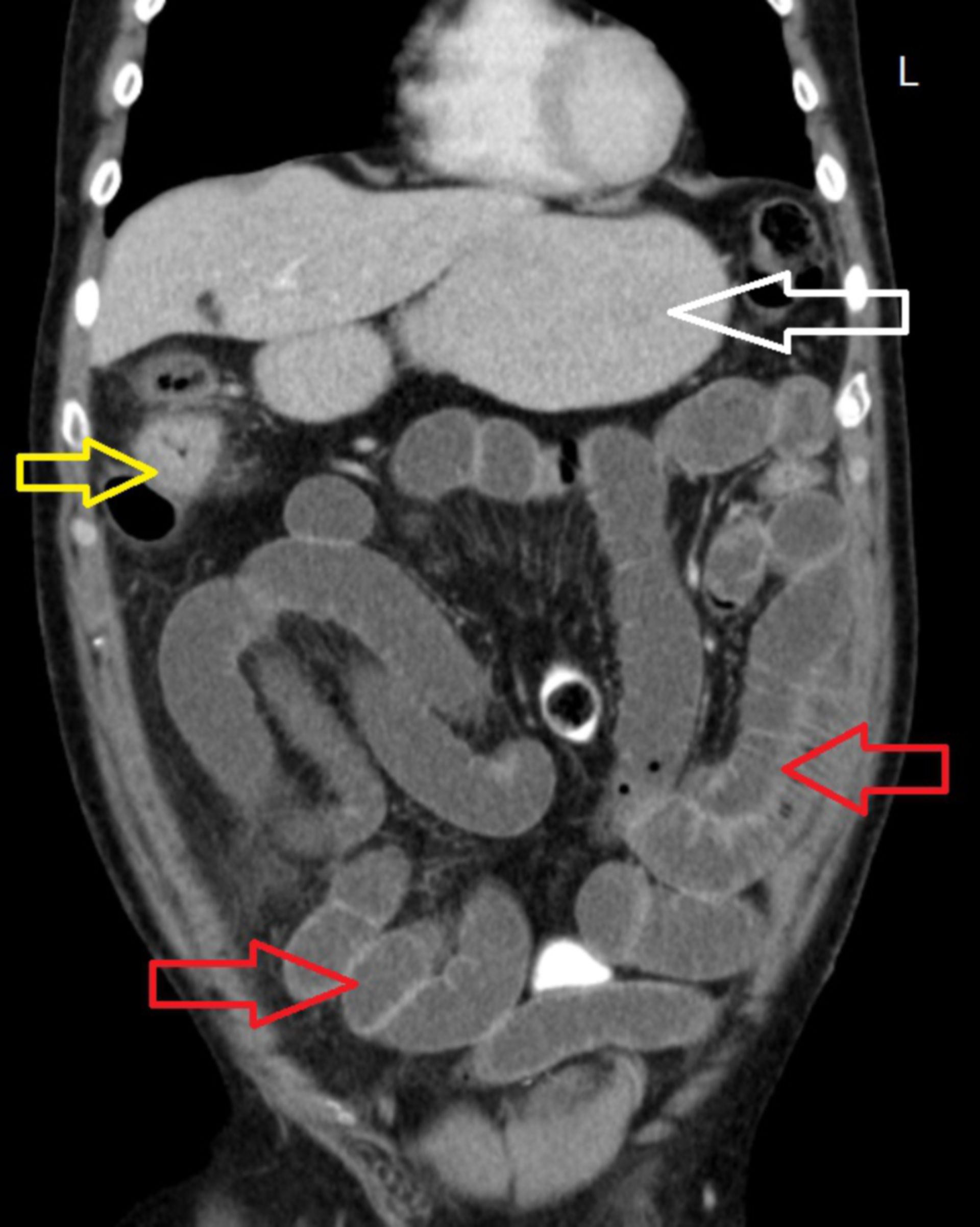 cor5: CT des Abdomens in frontaler Ebene