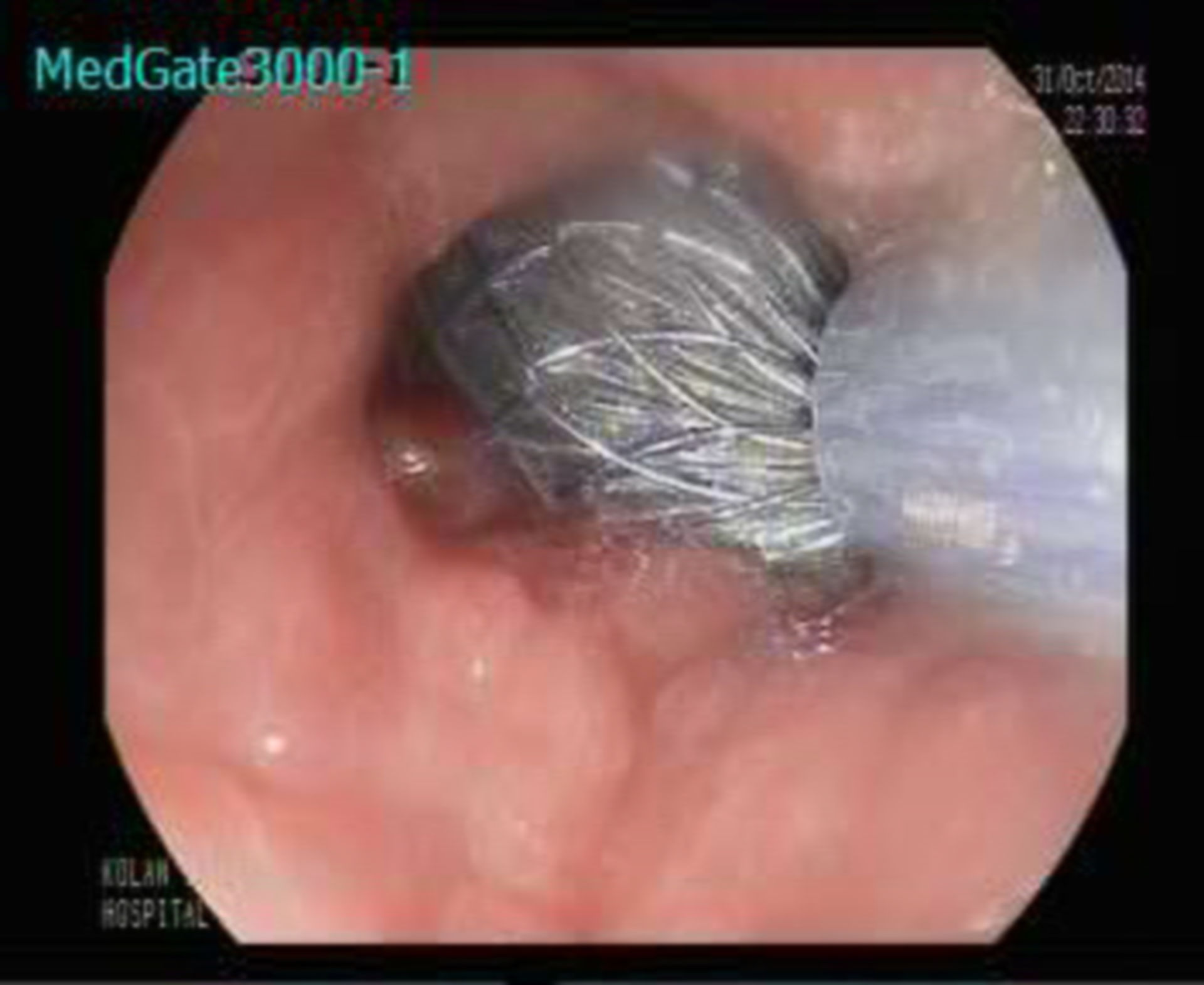 Opening a coated stend for the treatment of a sleeve gastrectomy leak