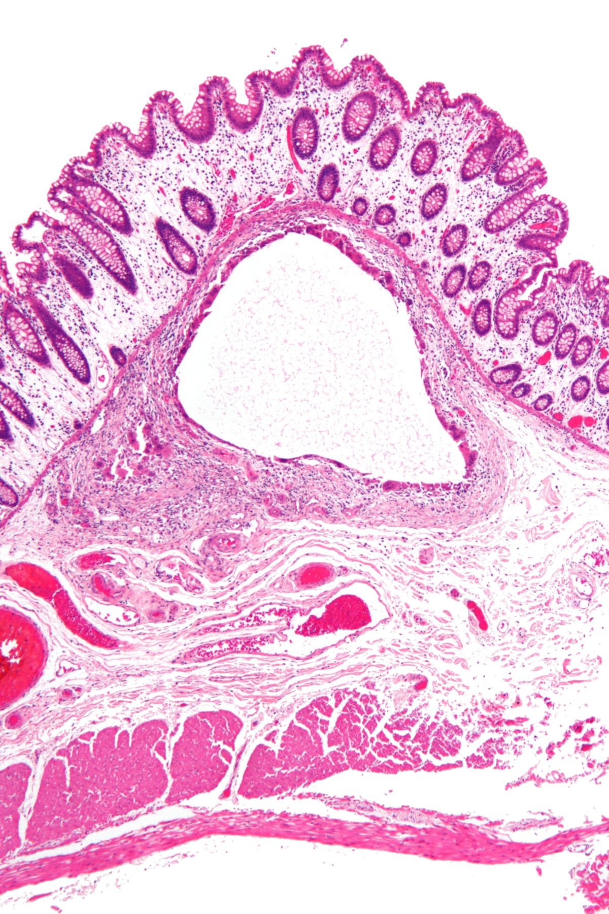 Pneumatosis cystoides intestinalis (Histologie)