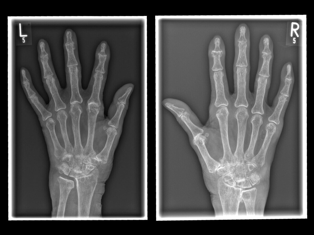 Rheumatoide Arthritis