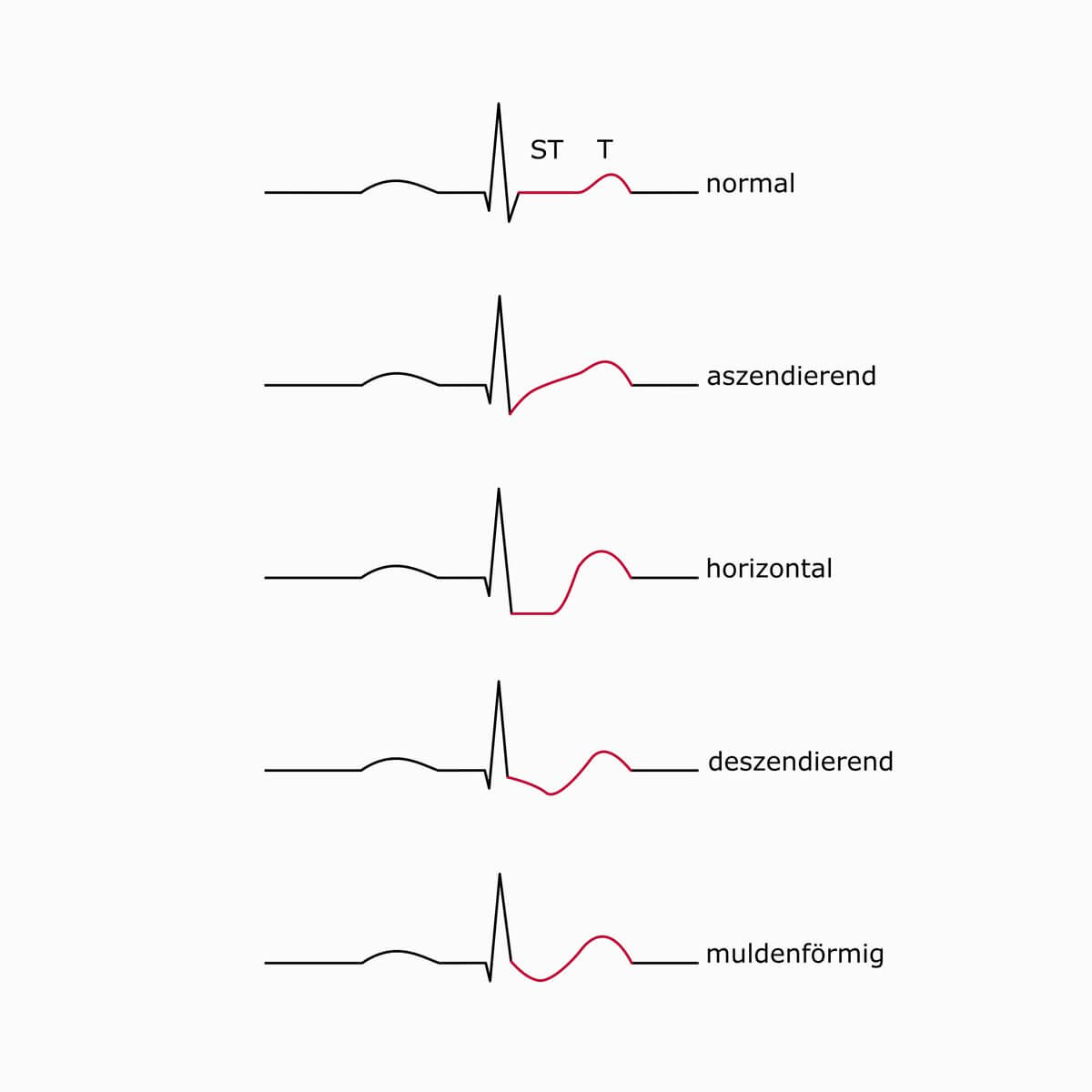 Schematische Darstellung von vier ST-Senkungsmorphologien