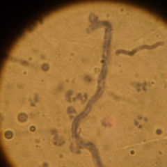 Loiasis DocCheck Flexikon