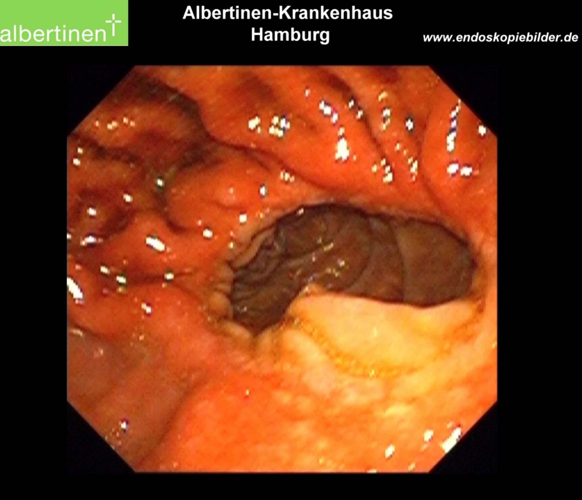 B-II anastomosis endo