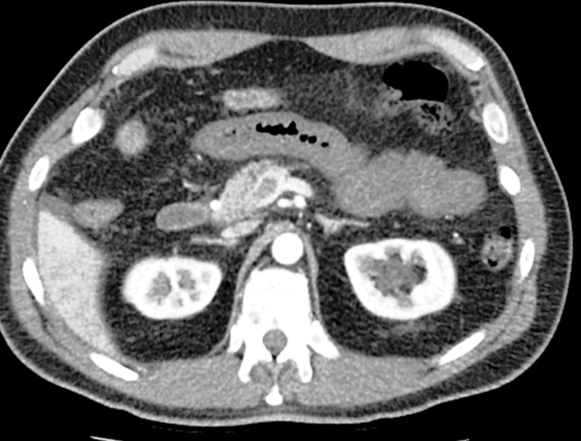 CT des Abdomens in transversaler Ebene mit Mesenterialvenenthrombose
