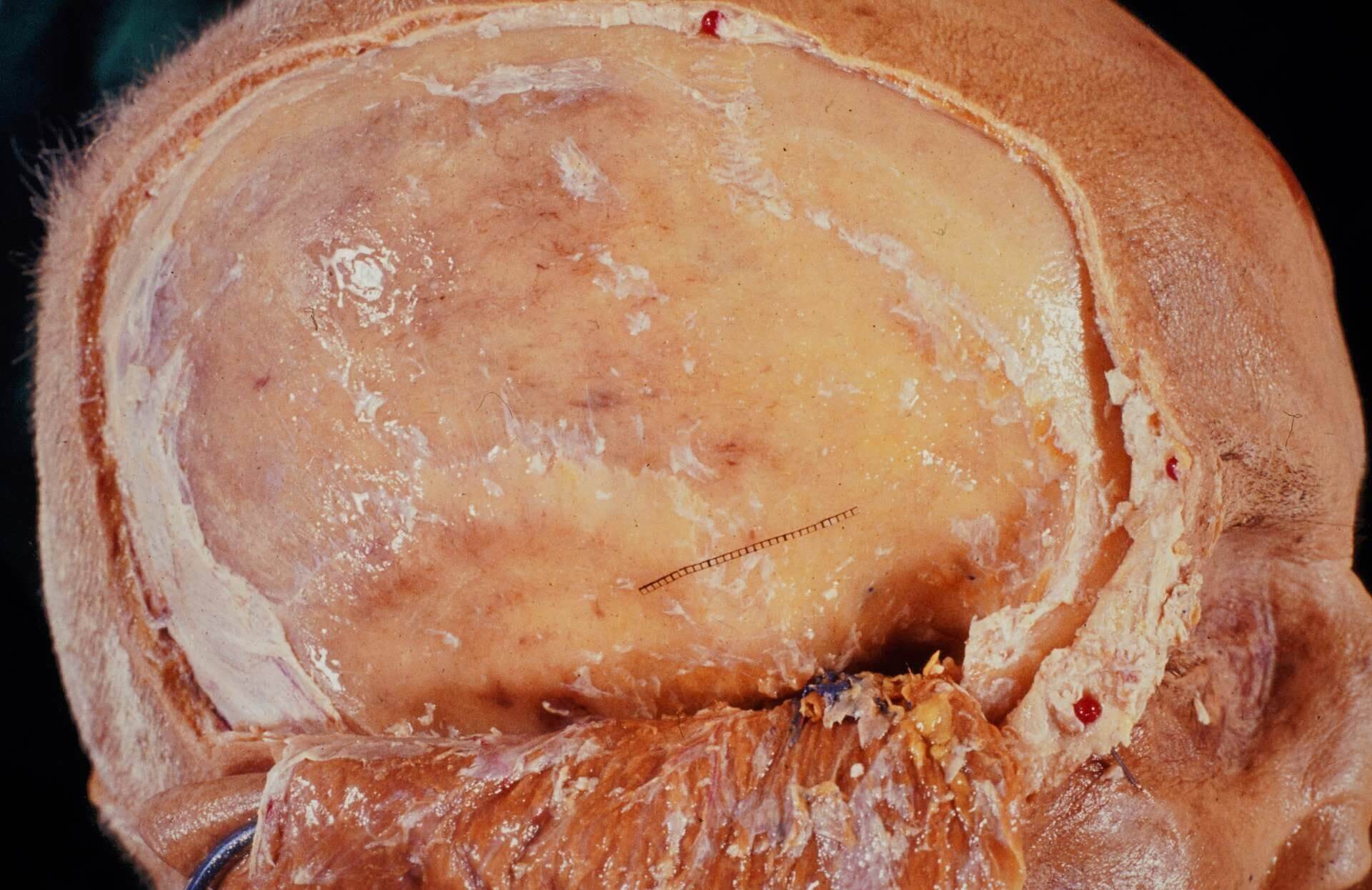 Fossa temporalis
