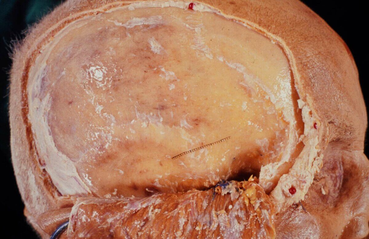 Fossa temporalis