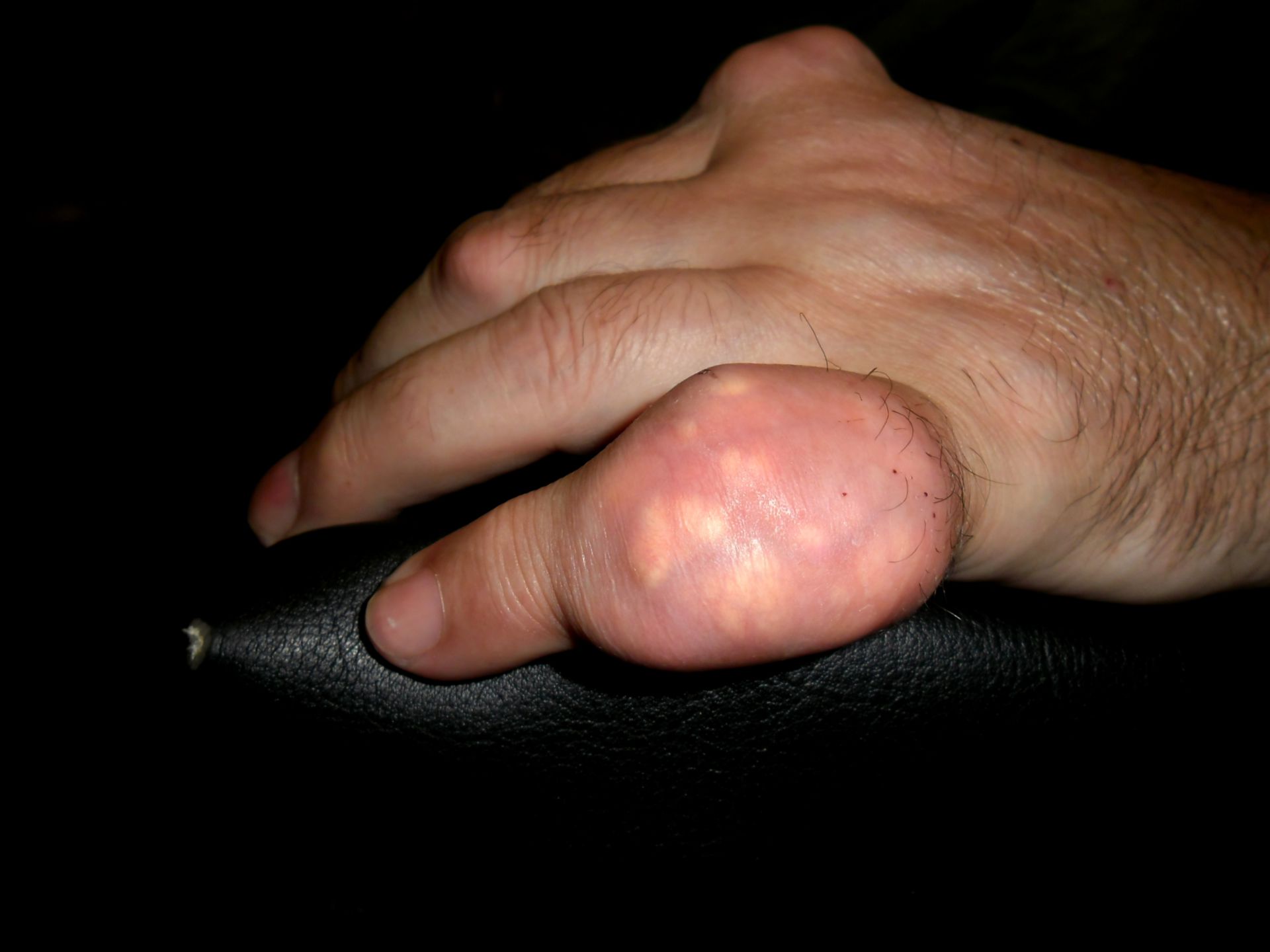 Gout finger