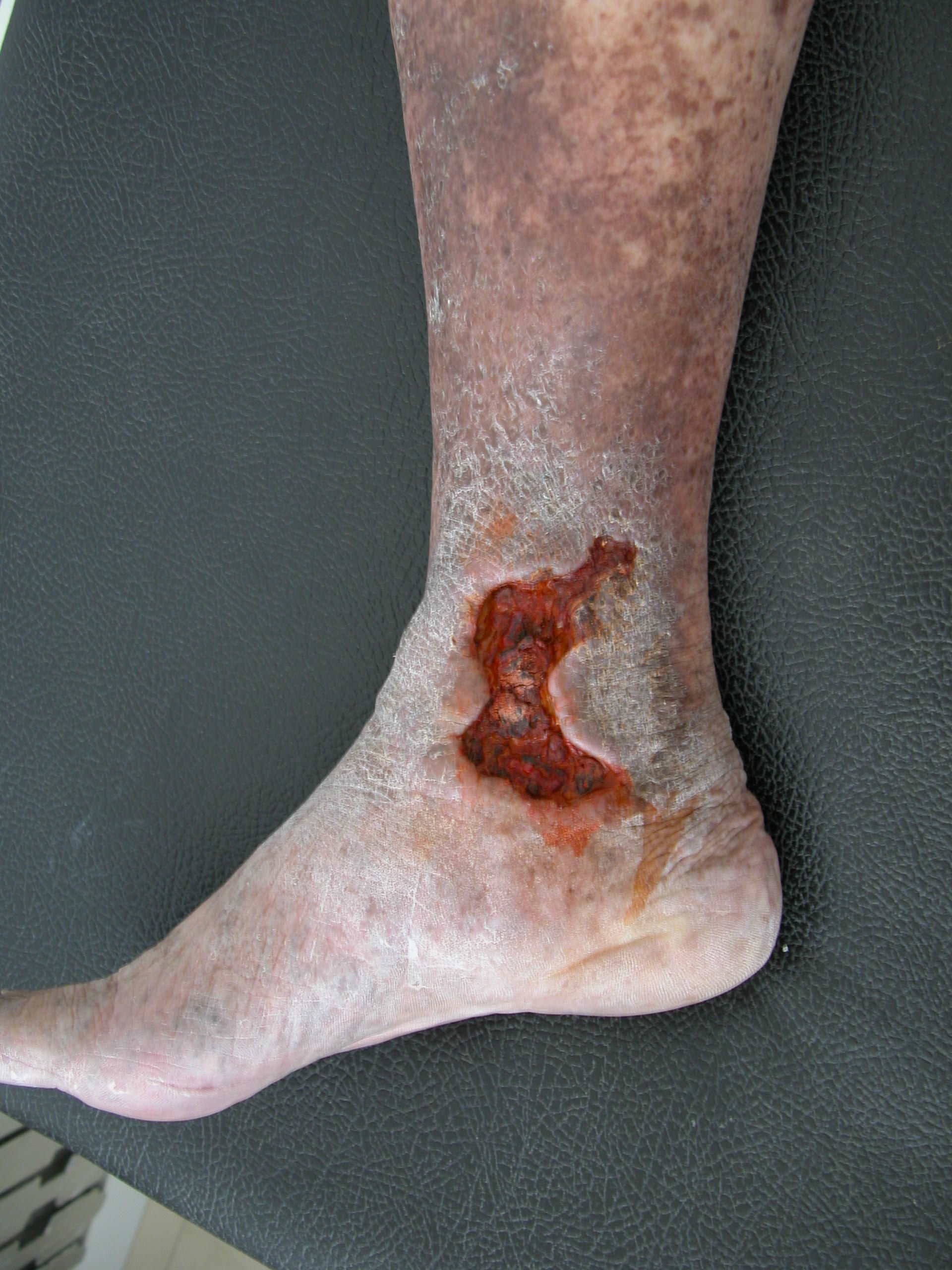 Ulcera delle gambe