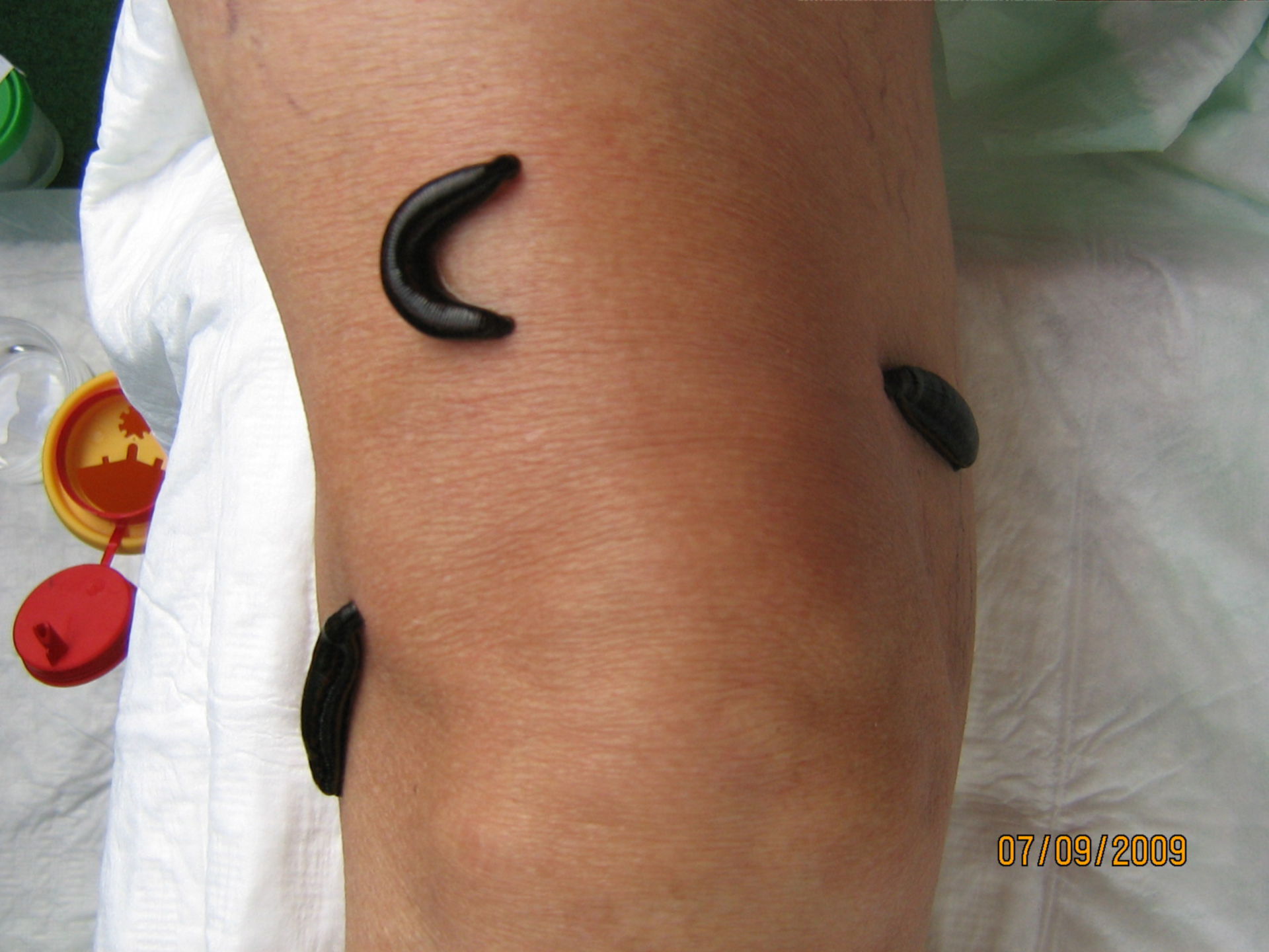 Leeches on knee- alternative therapy for arthrosis