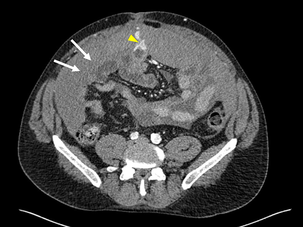 article_river_2e8be1f013f411ecafbd93da917b7708-fig1-varices_original.jpg