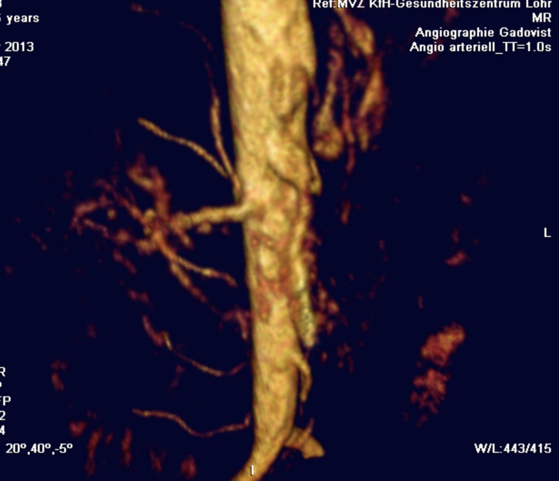 Angiographiebefund mit Kompression des Truncus coeliacus