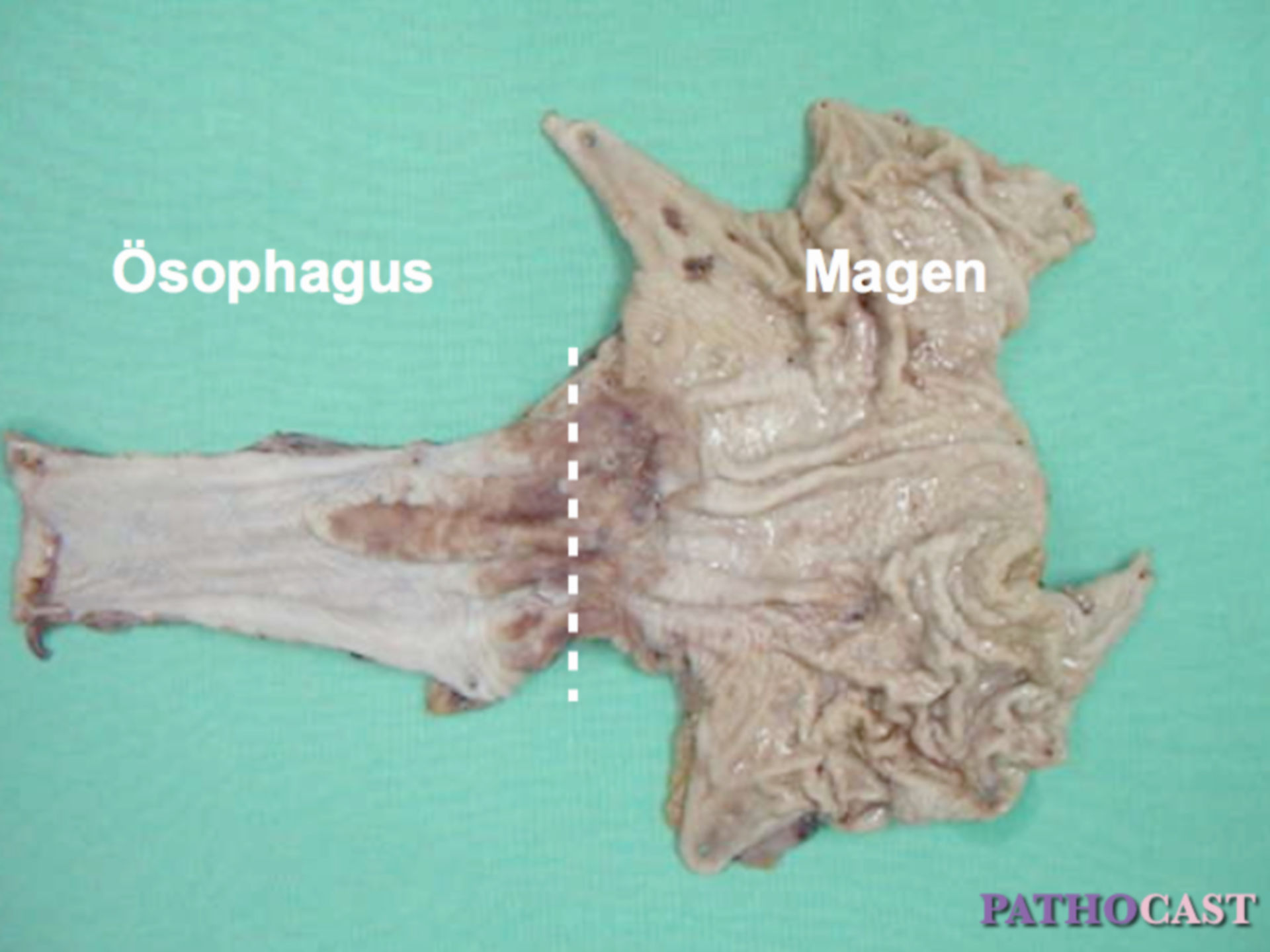 Long-segment Barrett-Ösophagus