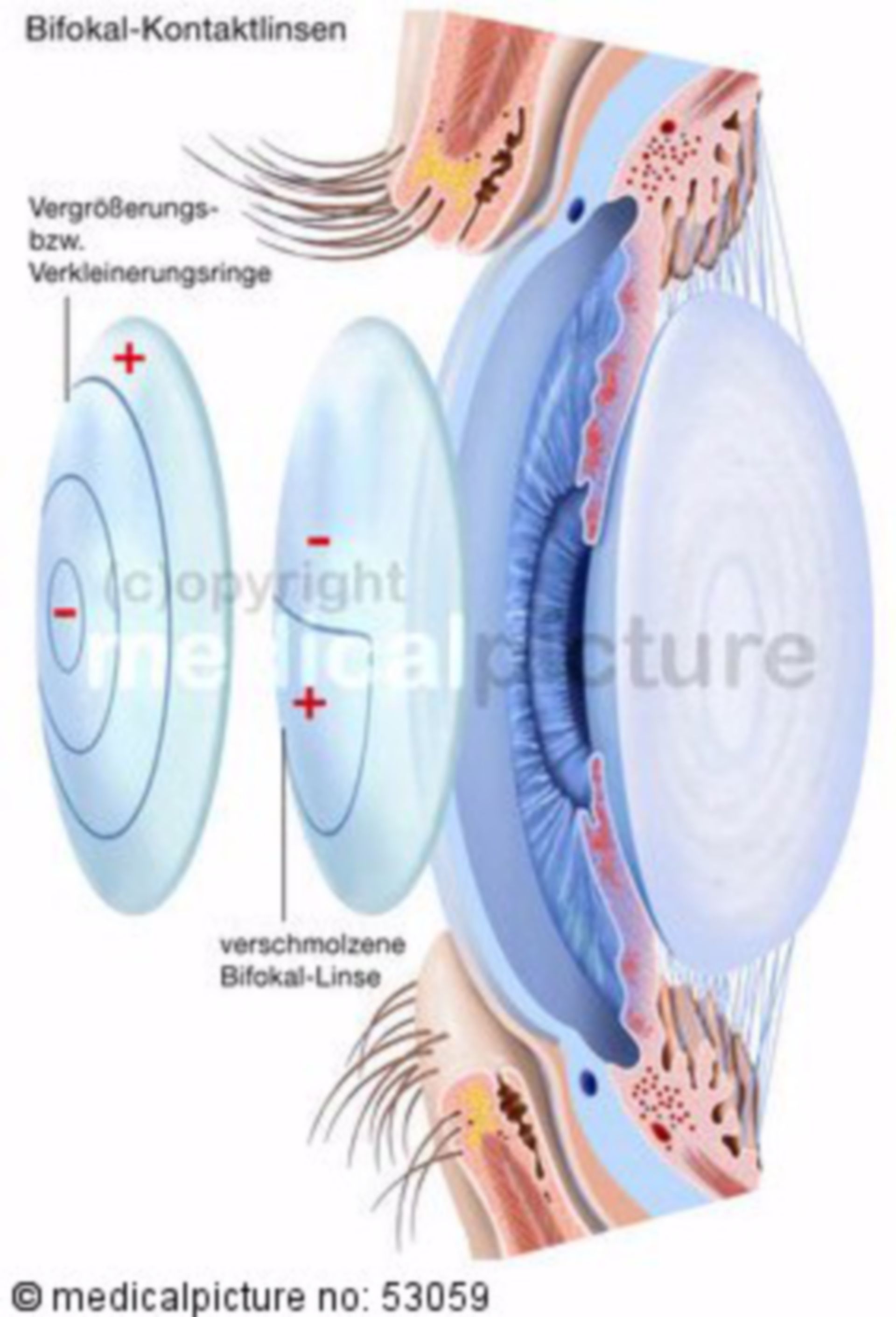 Bifocal contact lenses
