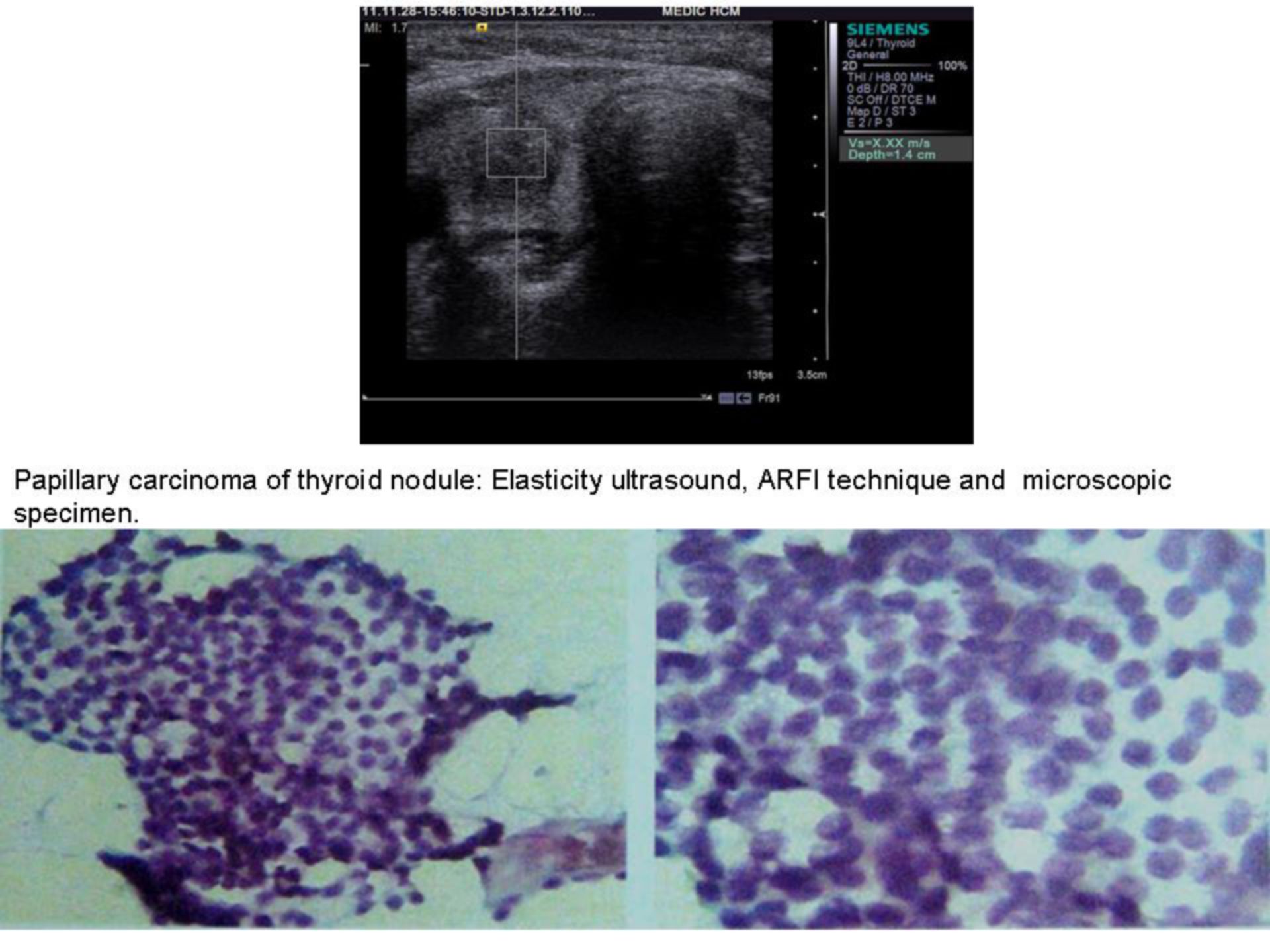 Glándula tiroides (Fibroscan) 2