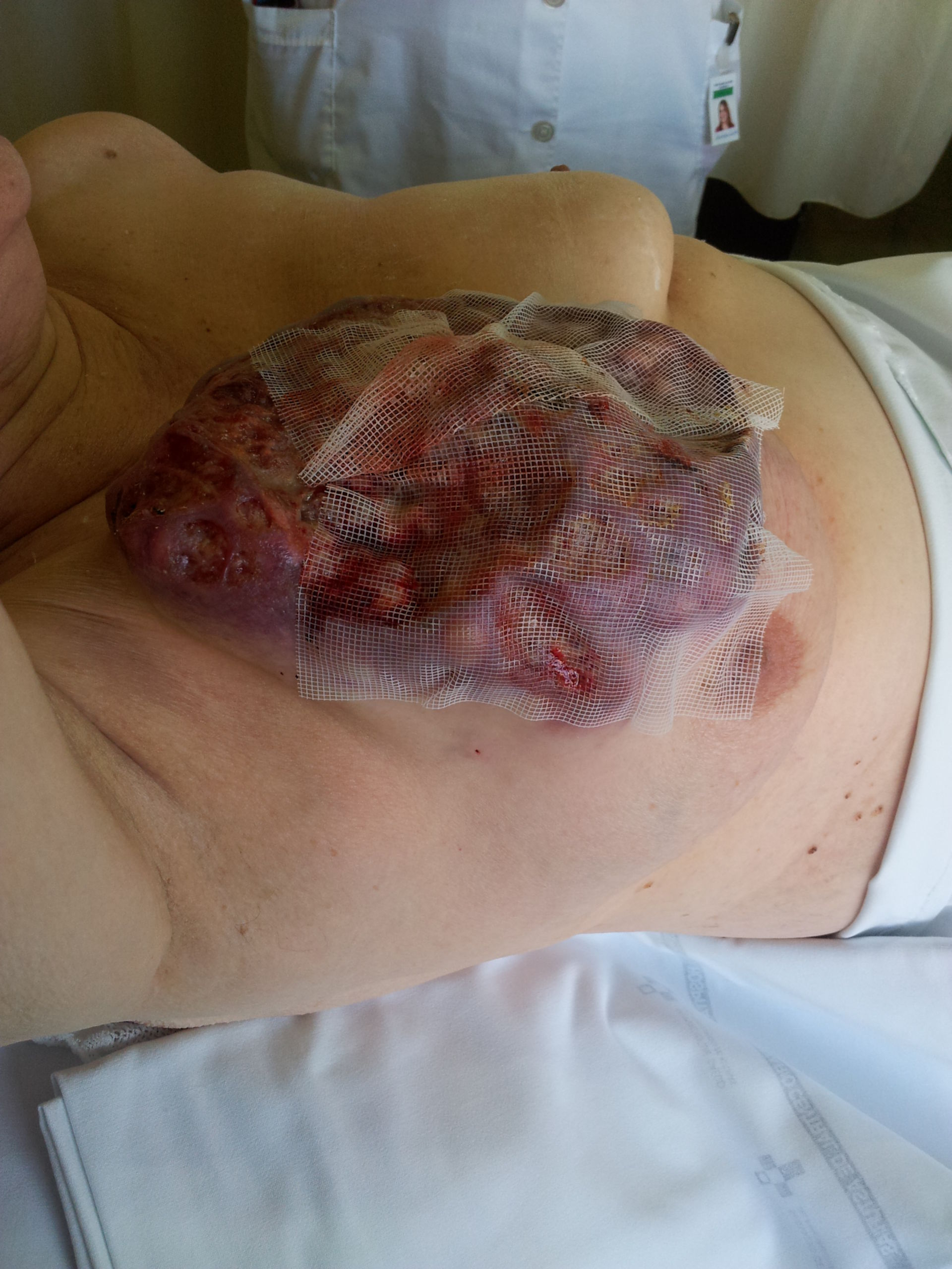 Carcinoma mammario (2)