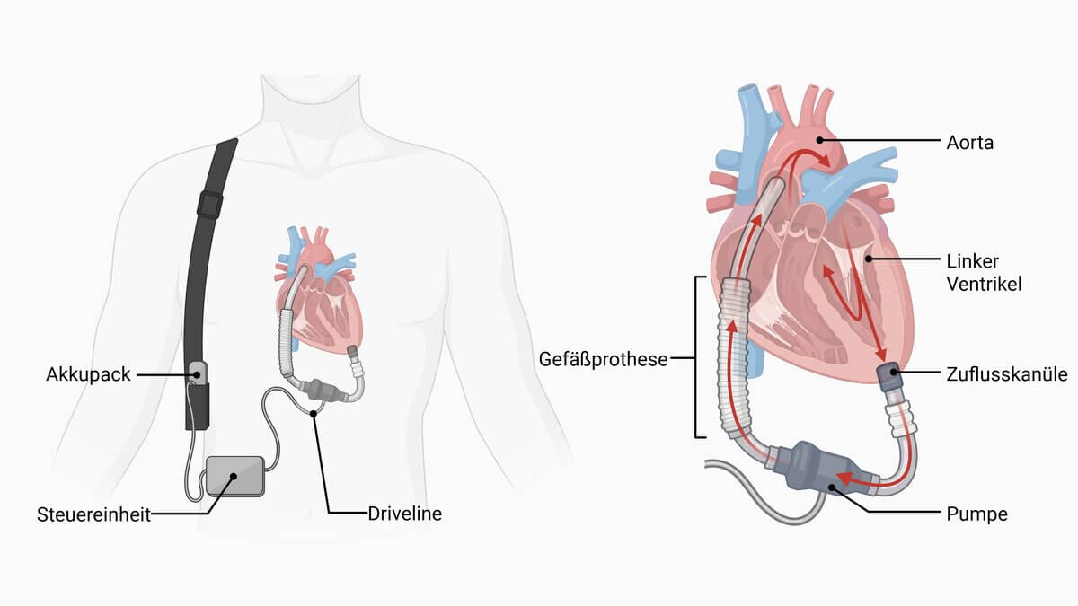 Linksventrikuläres Herzunterstützungssystem (LVAD)