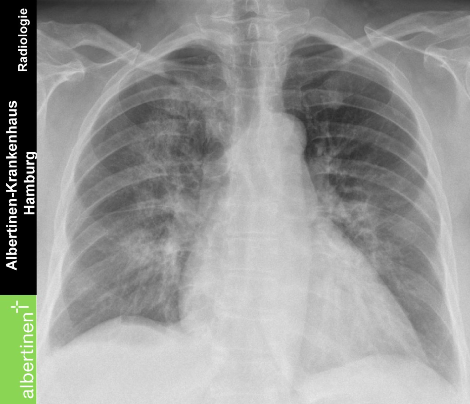 Rö-Thorax Bronchopneumonie bds pa