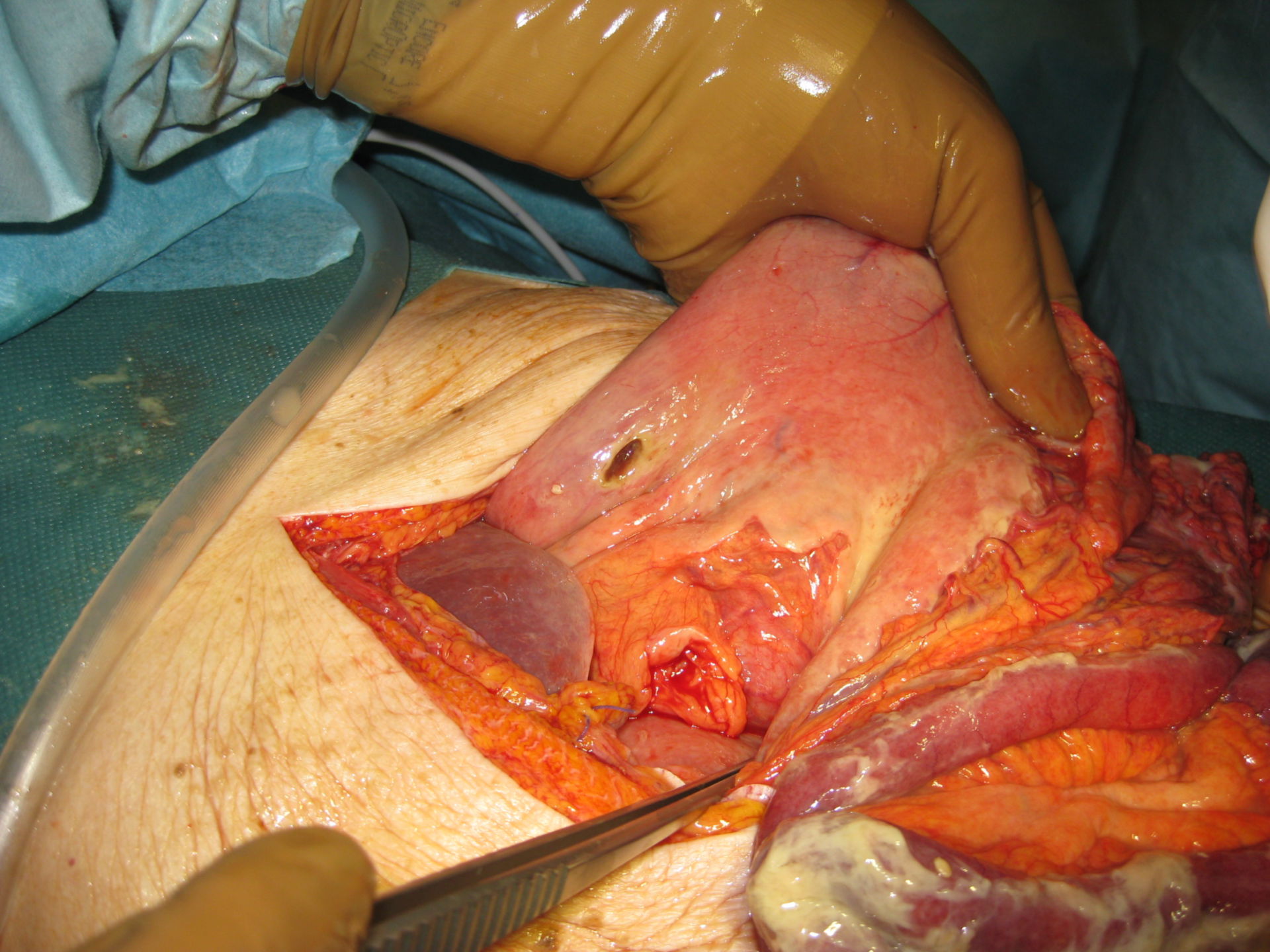 Perforated gastric ulcer