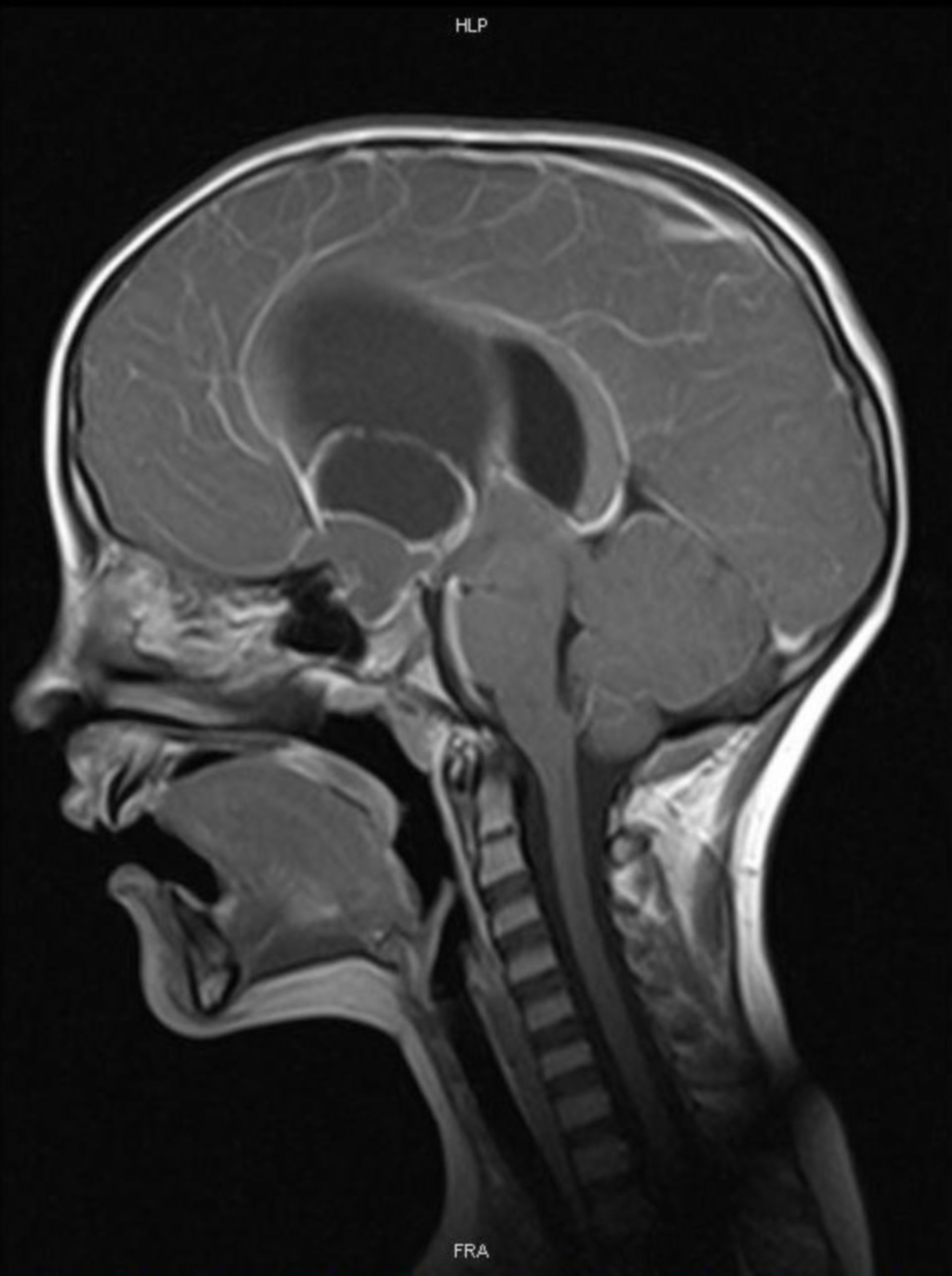 Craniopharyngeoma