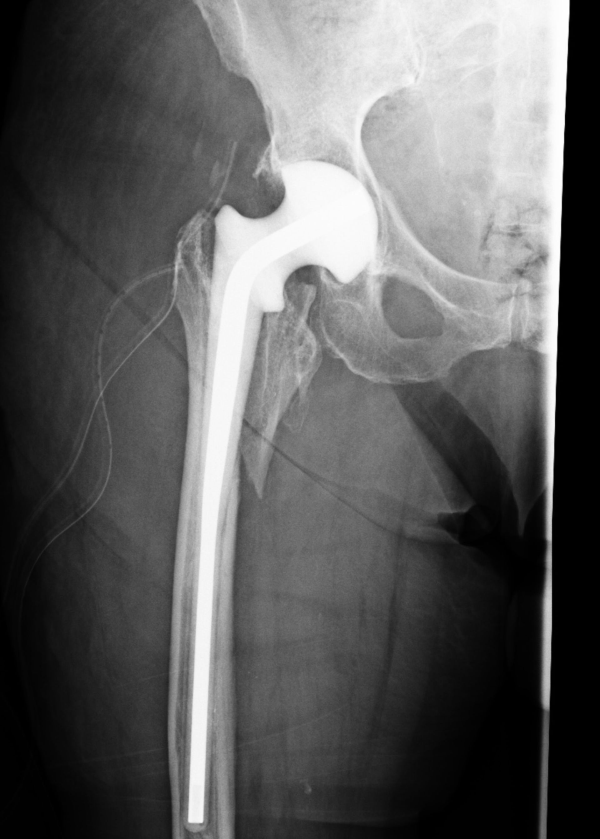 Hip spacer after prosthesis removal